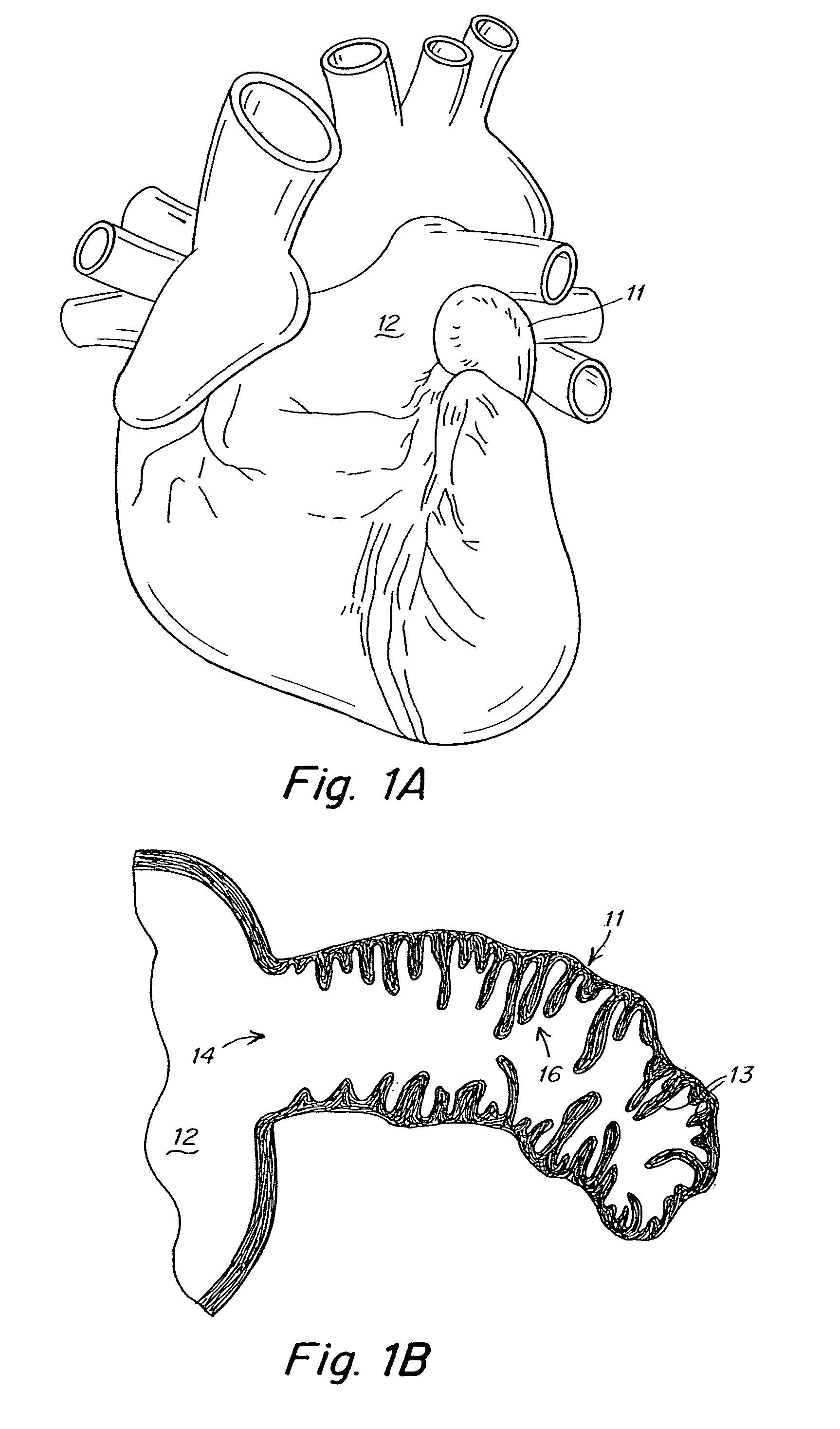 Device and methods for preventing formation of thrombi in the left atrial appendage