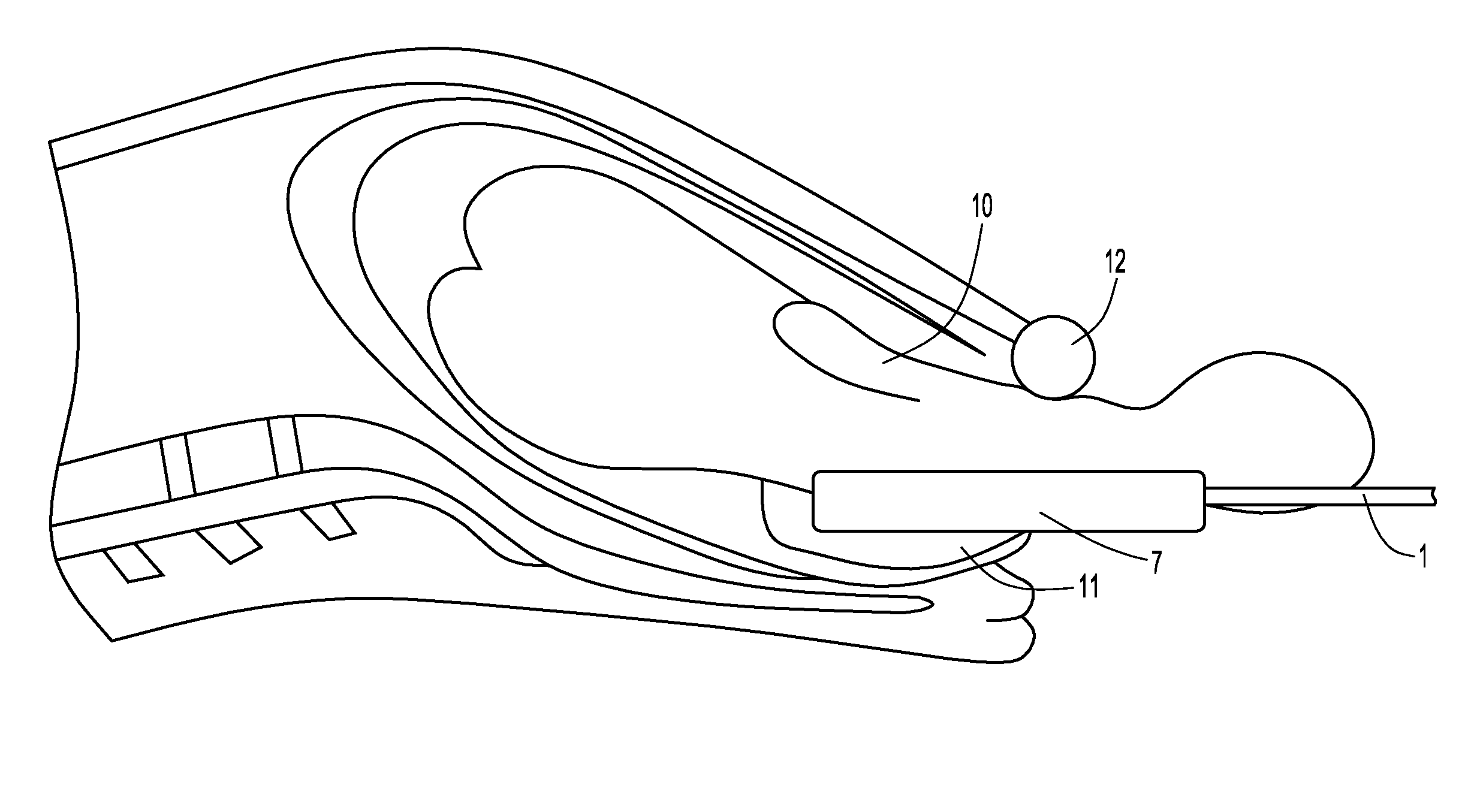 Scapuloblade Shoulder Dystocia Device