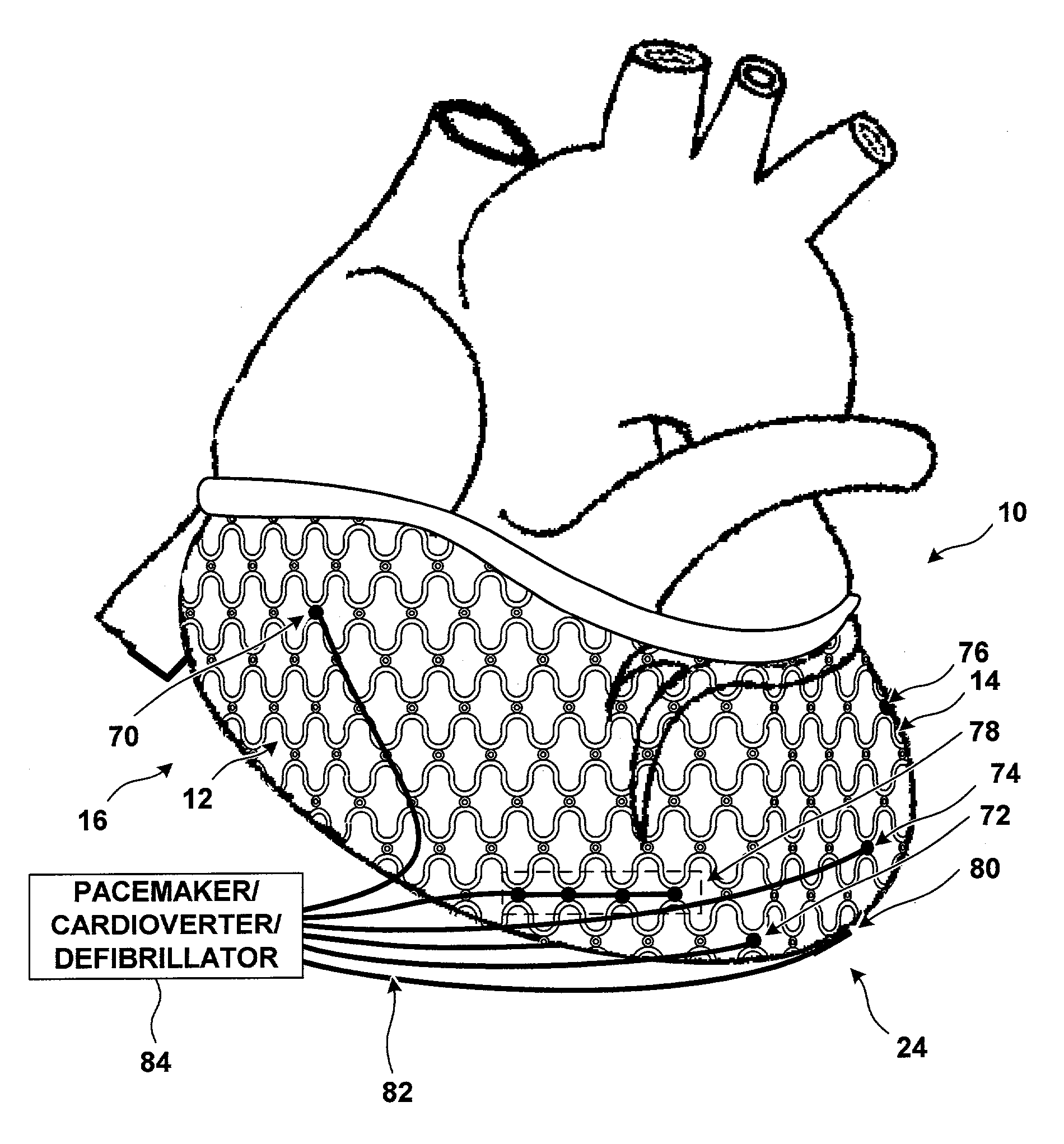 Cardiac restraint with electrode attachment sites