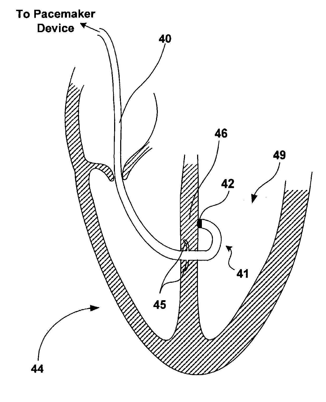 Medical lead designs for lead placement through tissue