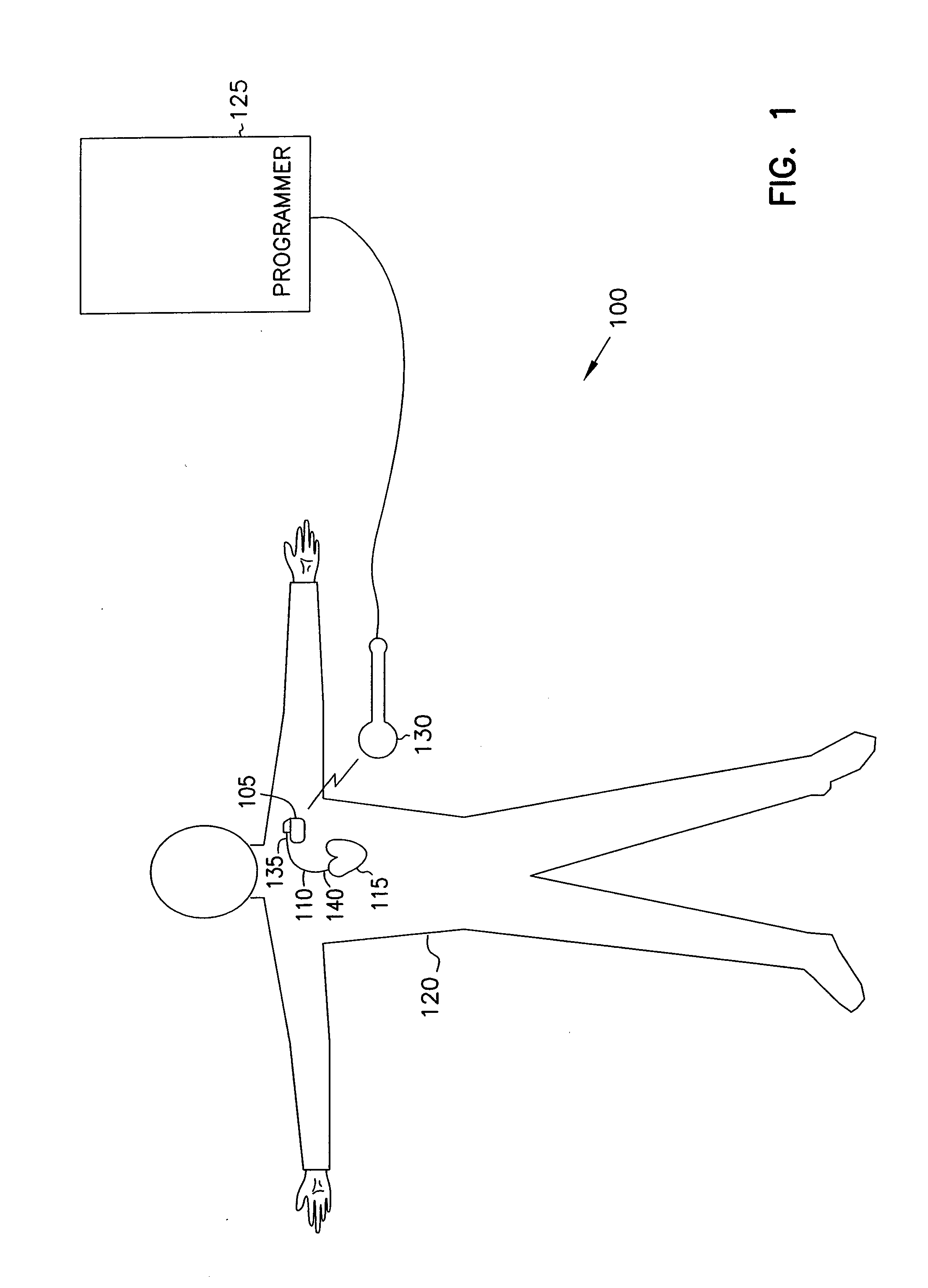 Method and apparatus for treating irregular ventricular contractions such as during atrial arrhythmia