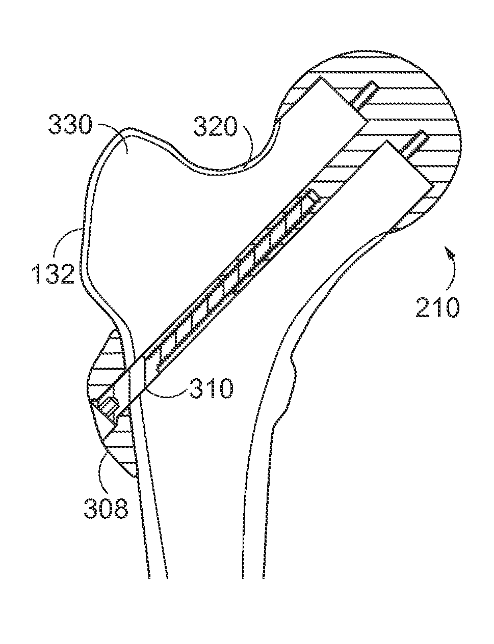 Variable hip resurfacing femoral implant