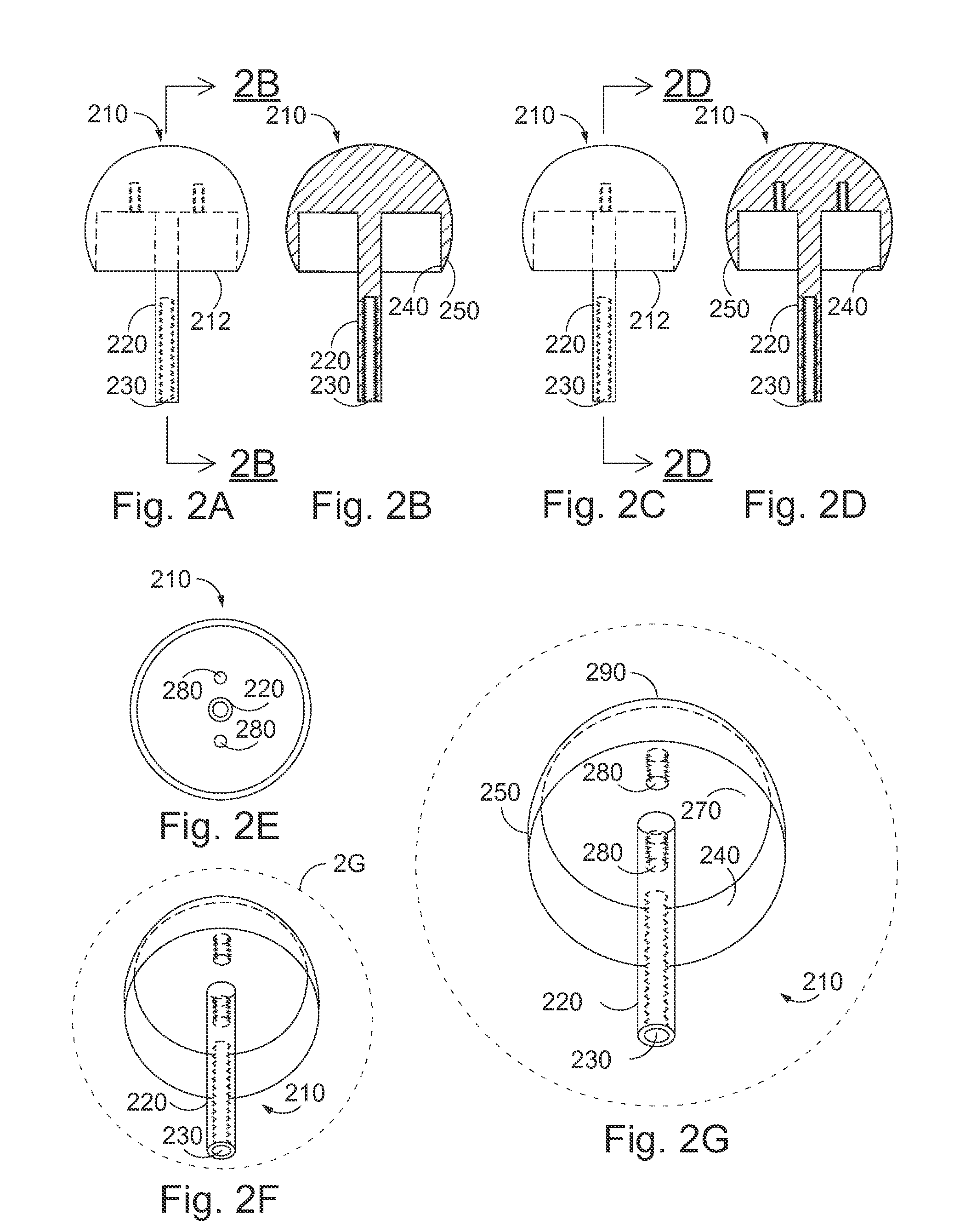 Variable hip resurfacing femoral implant