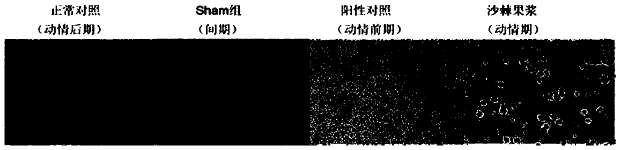 Application of sea-buckthorn fruit pulp in treatment of PCOS (polycystic ovary syndrome)