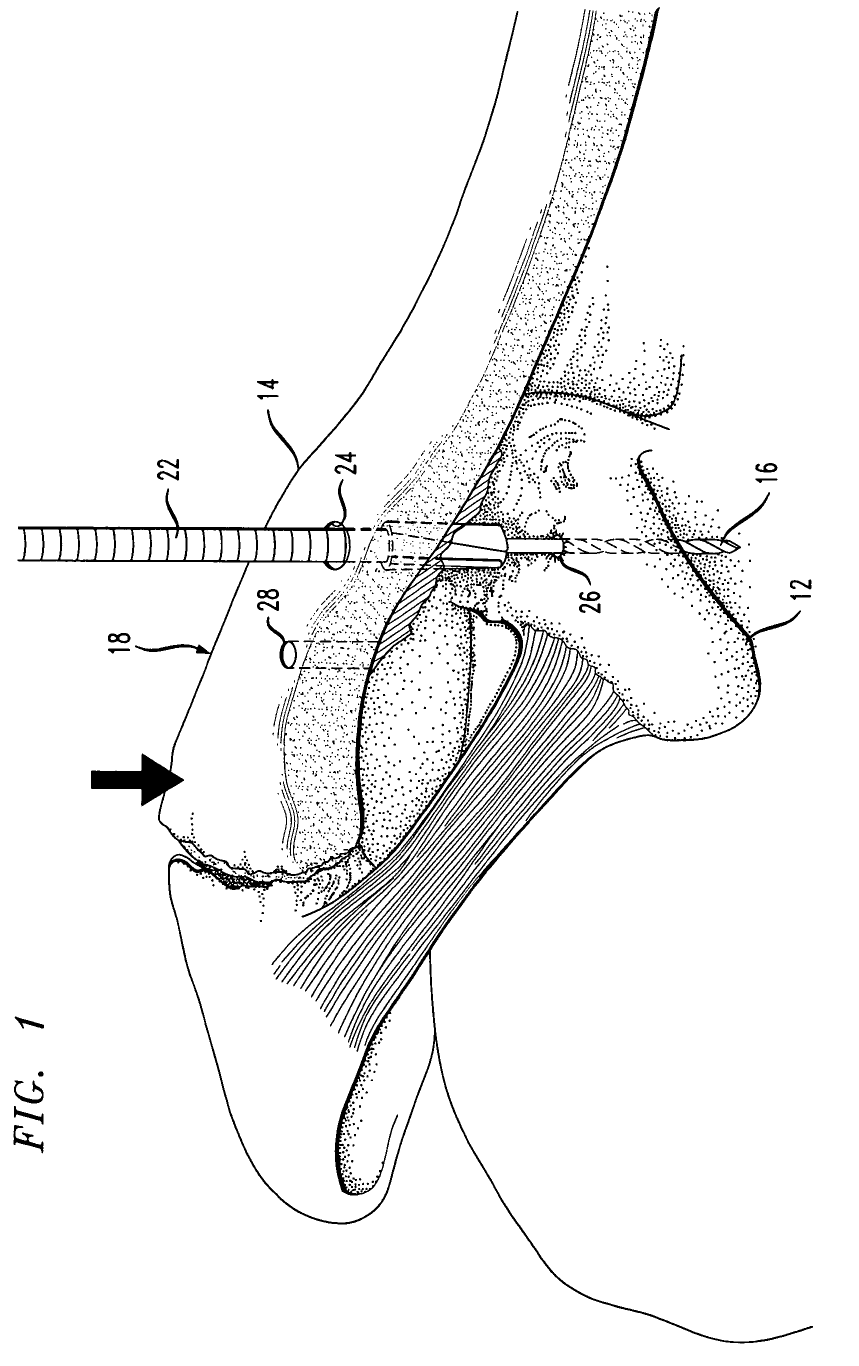 Device for treatment of acromioclavicular joint dislocations