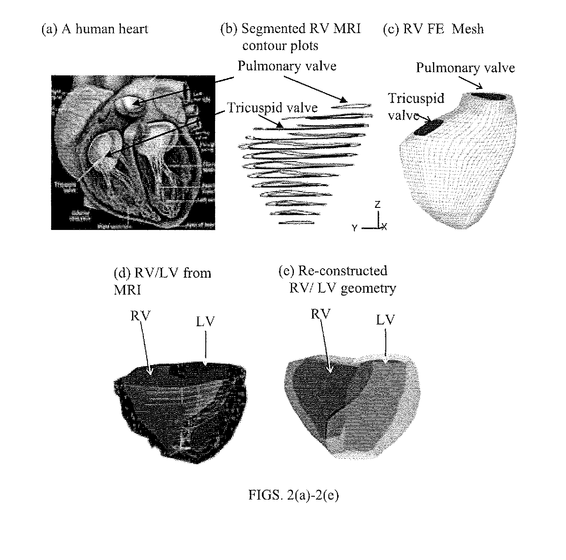 Patient-specific image-based computational modeling and techniques for human heart surgery optimization