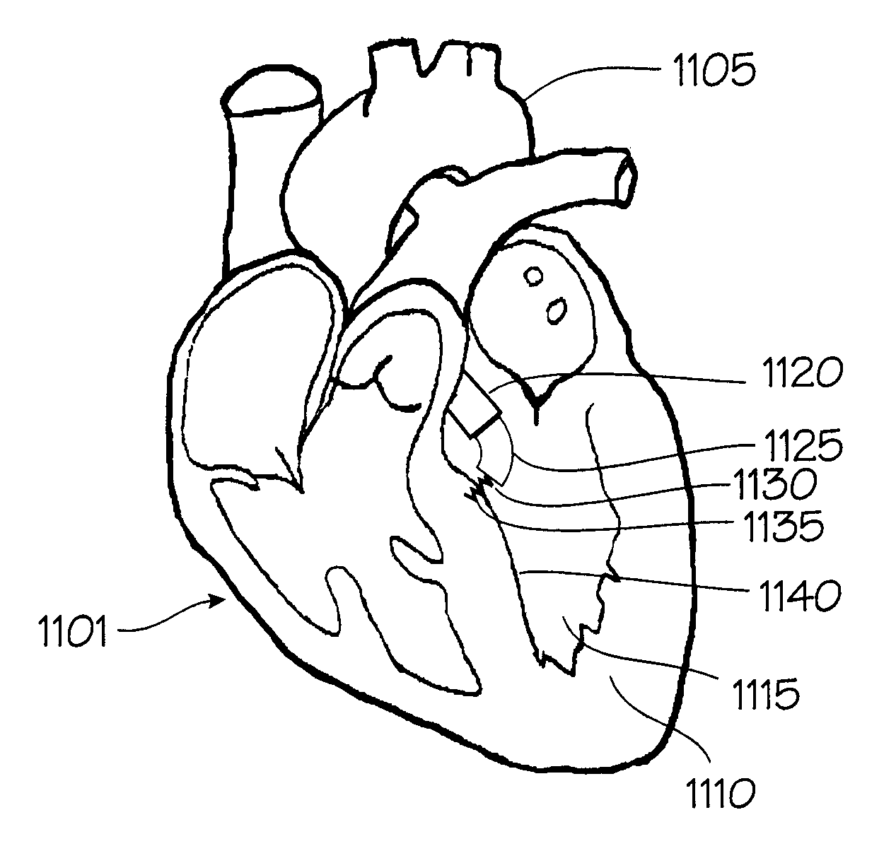 Drug delivery catheters that attach to tissue and methods for their use