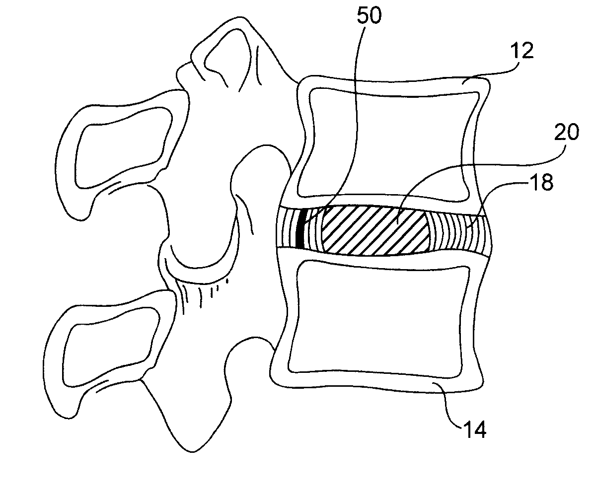 Spinal disc annulus augmentation