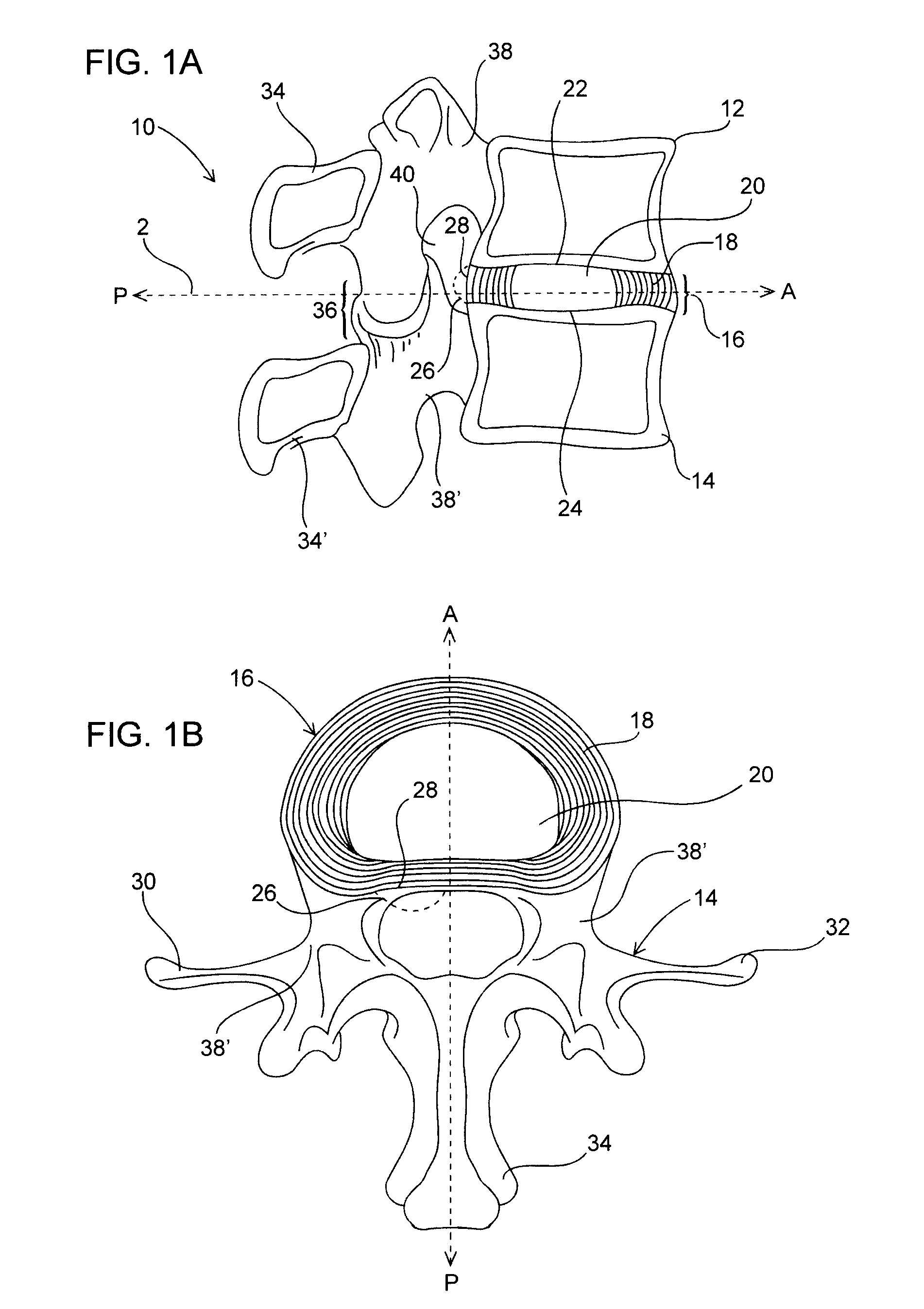 Spinal disc annulus augmentation