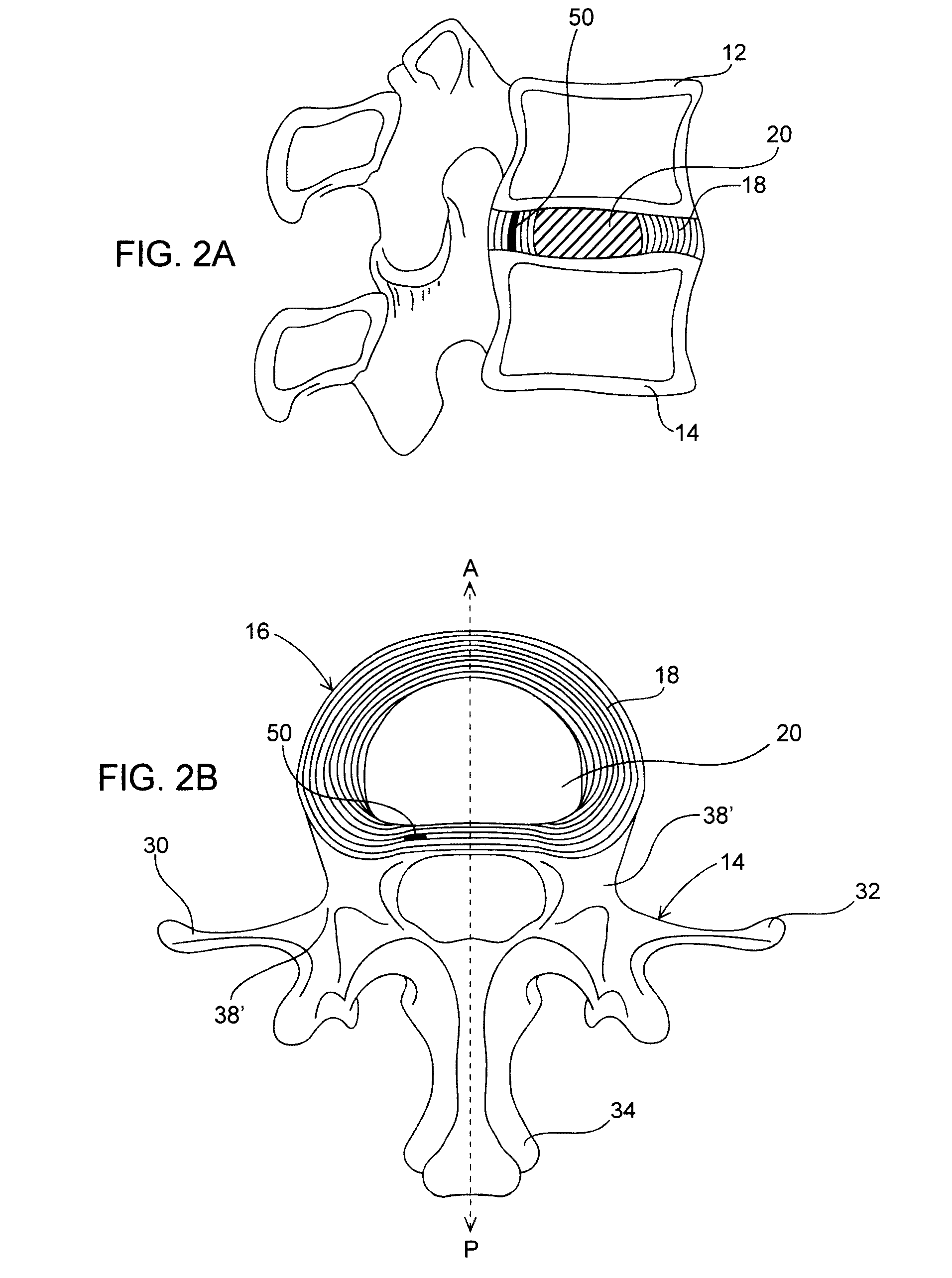 Spinal disc annulus augmentation