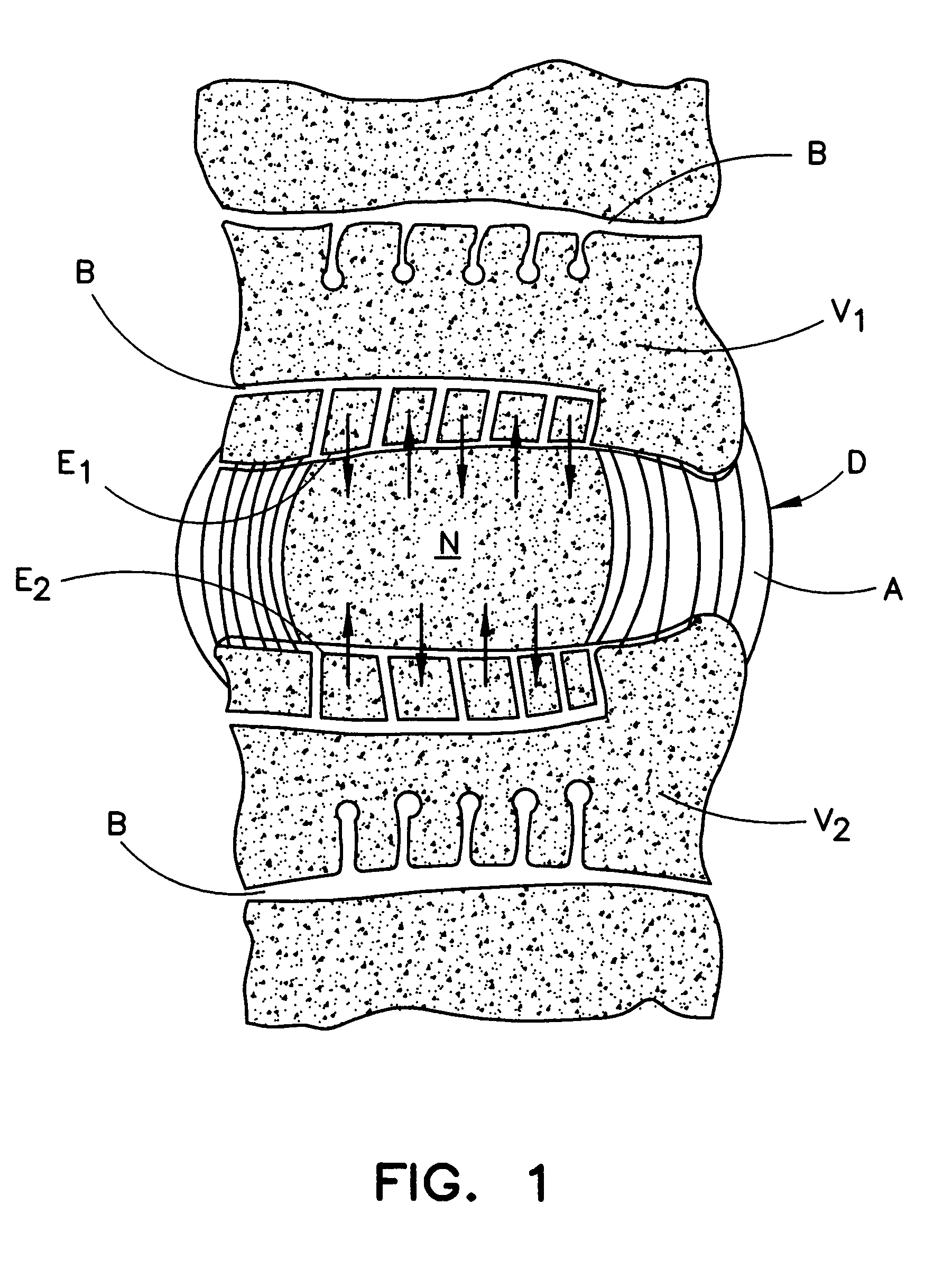 System and method for the pretreatment of the endplates of an intervertebral disc