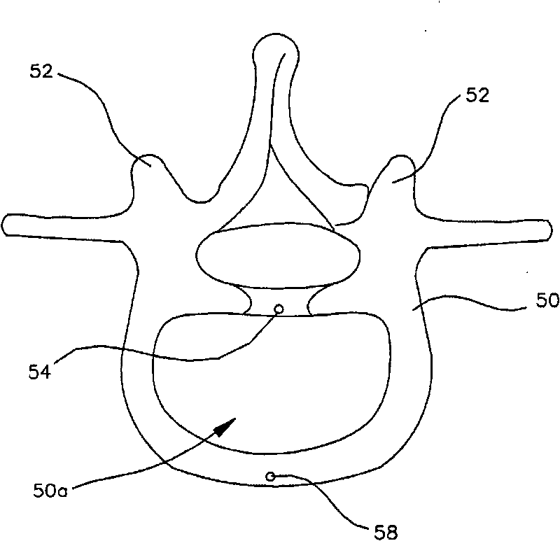 Multi-lobe artificial spine joint