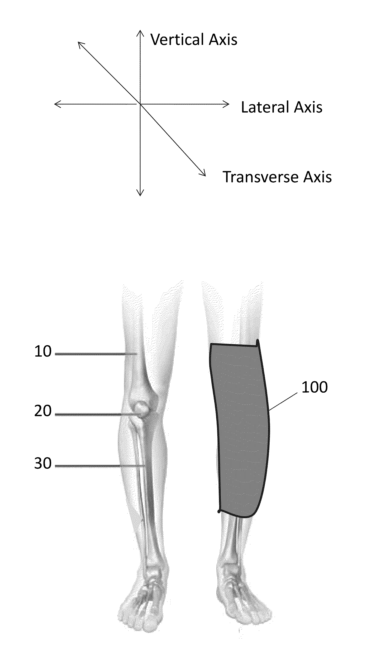 Wearable device configured to detect improper movement of a knee and alert wearers to the improper movement