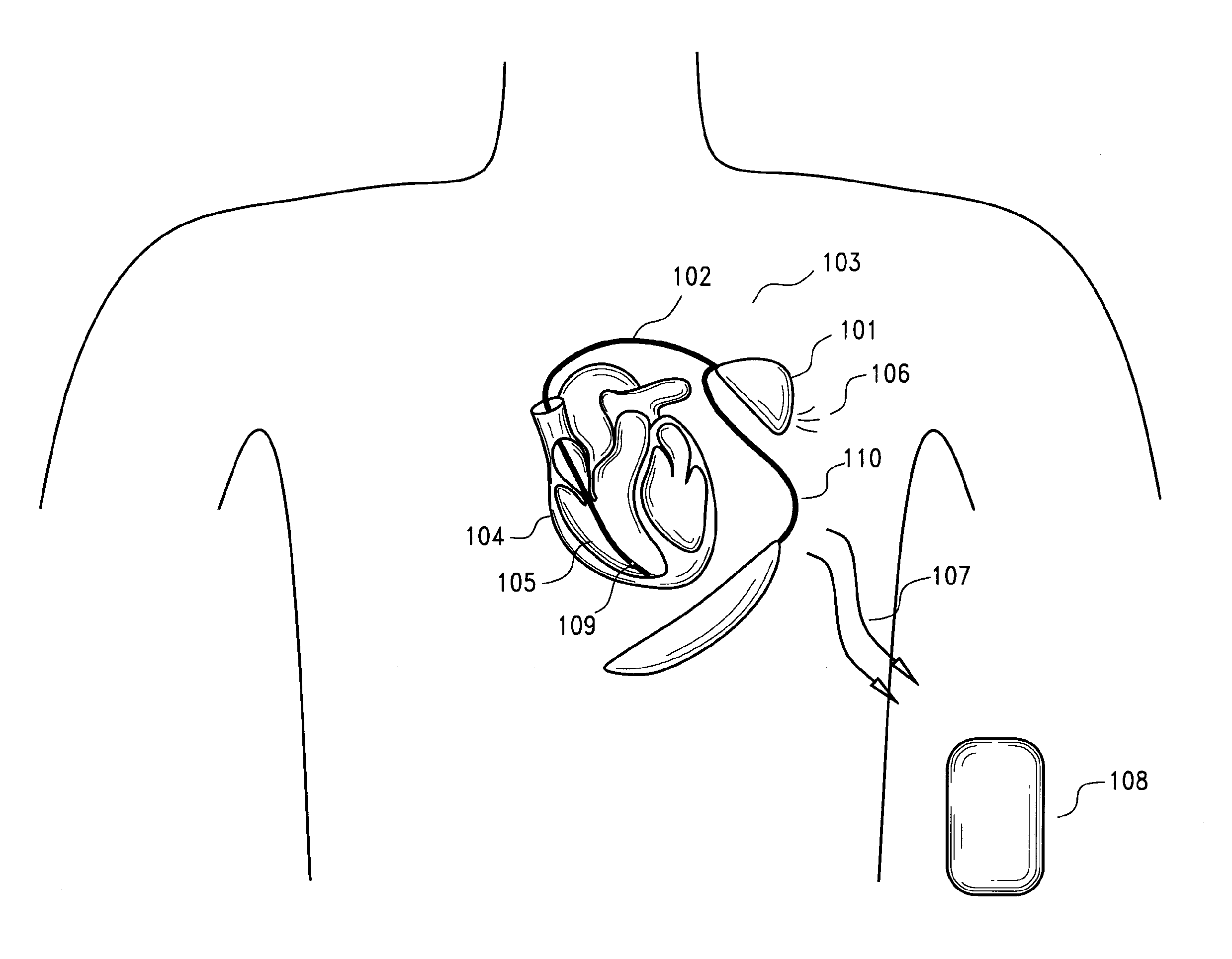 Implantable myocardial ischemia detection, indication and action technology