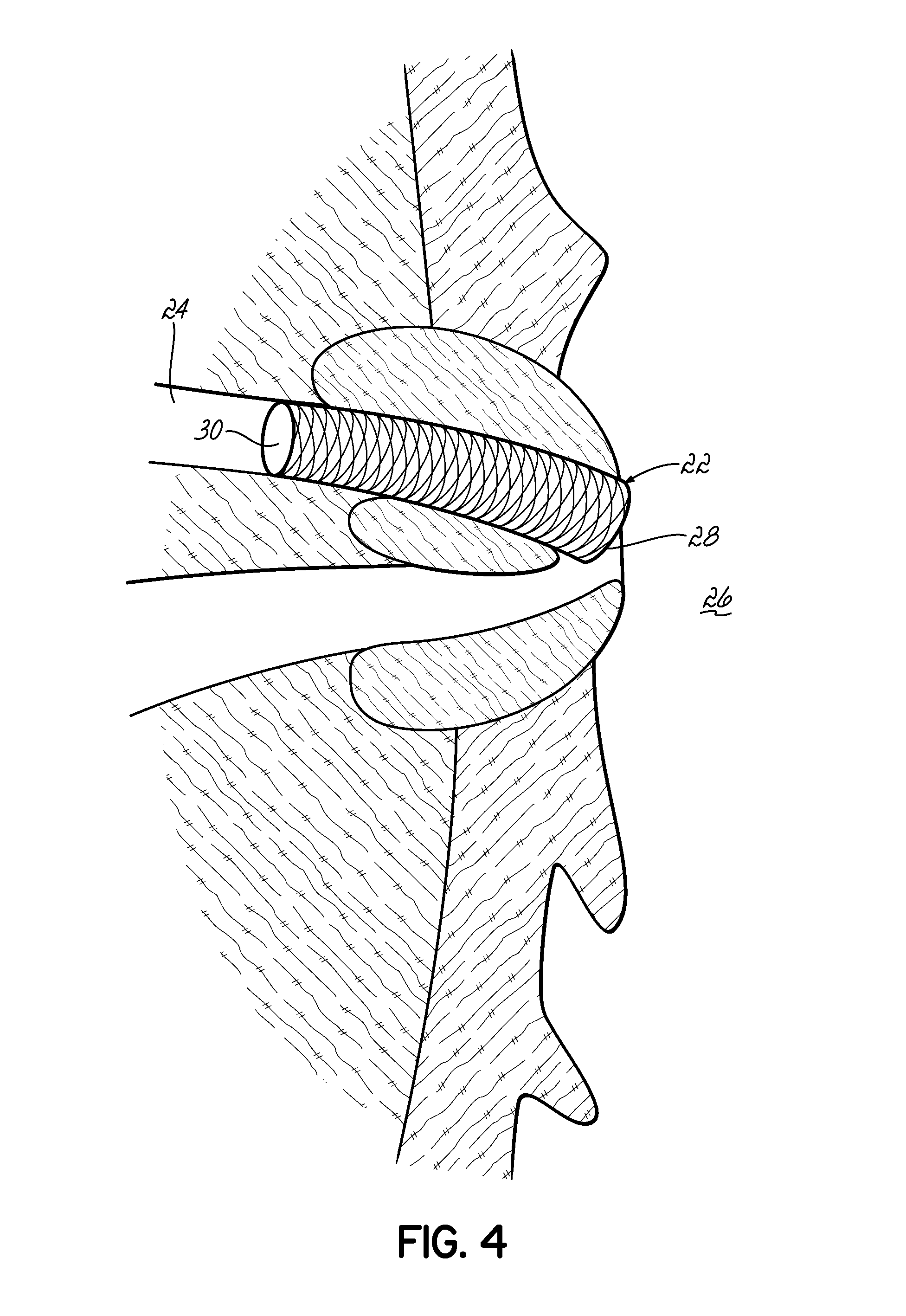 Method of treating cholangiocarcinoma and apparatus