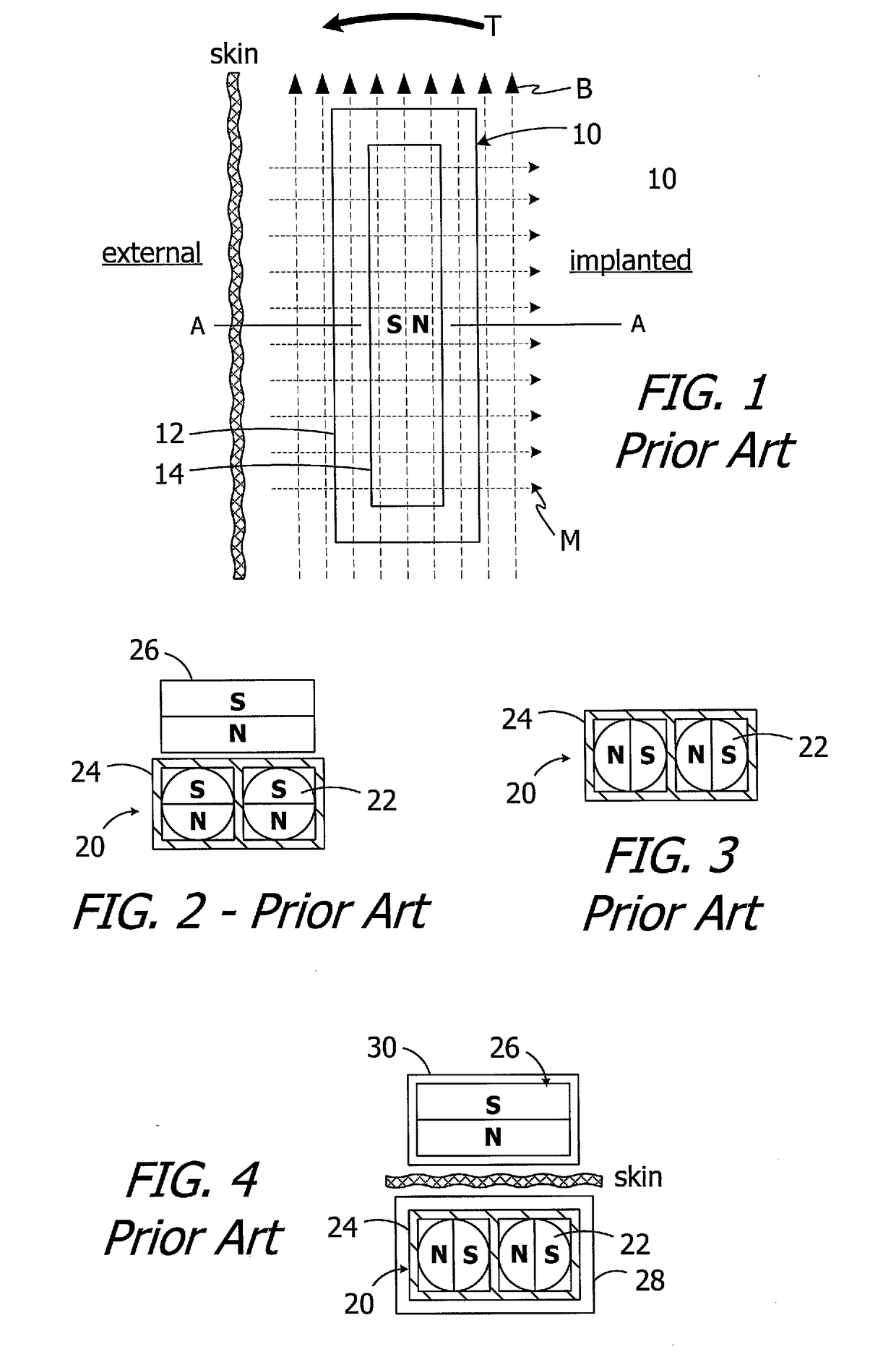 Cochlear implants having mri-compatible magnet apparatus