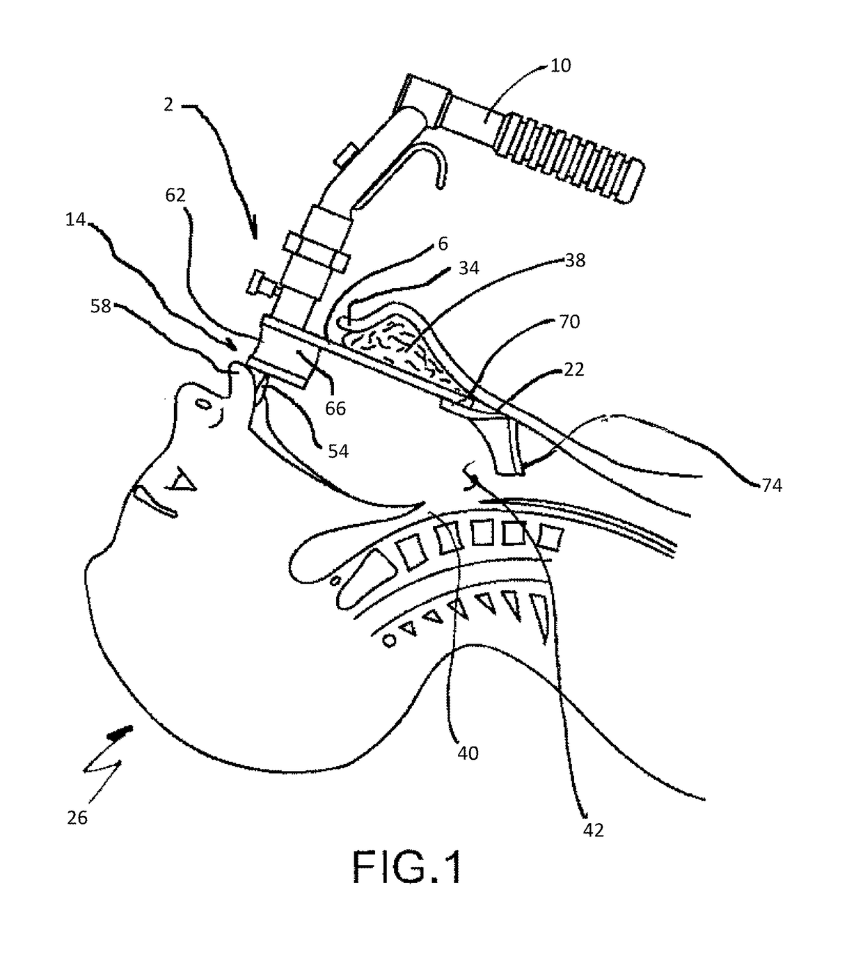 Retractor and tip extender therefor