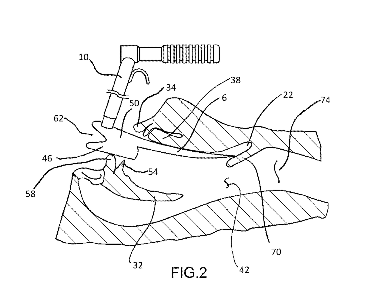 Retractor and tip extender therefor