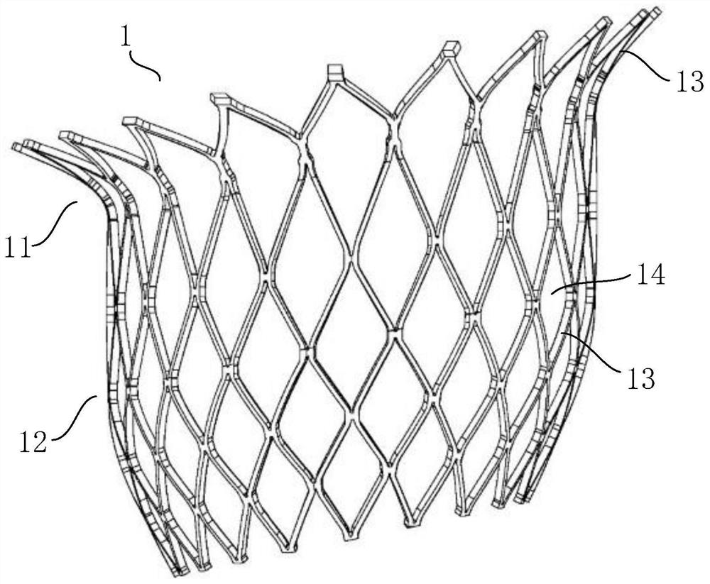 Interventional mitral valve stent