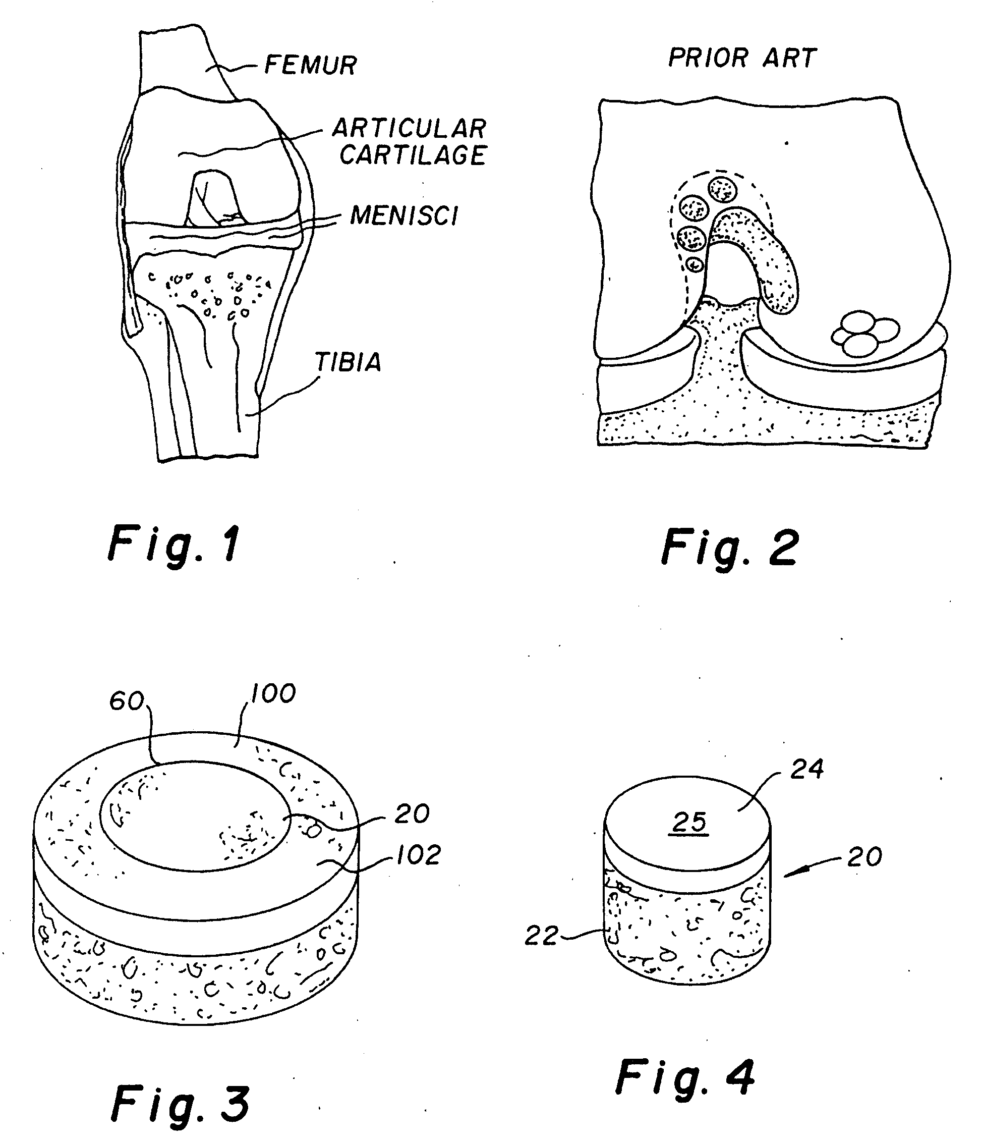 Cartilage allograft plug