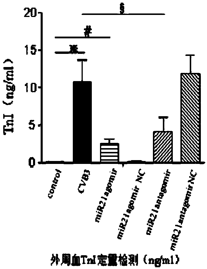 Targeted treating medicine for cardiac microangiopathy caused by Coxsackie B3 virus infection