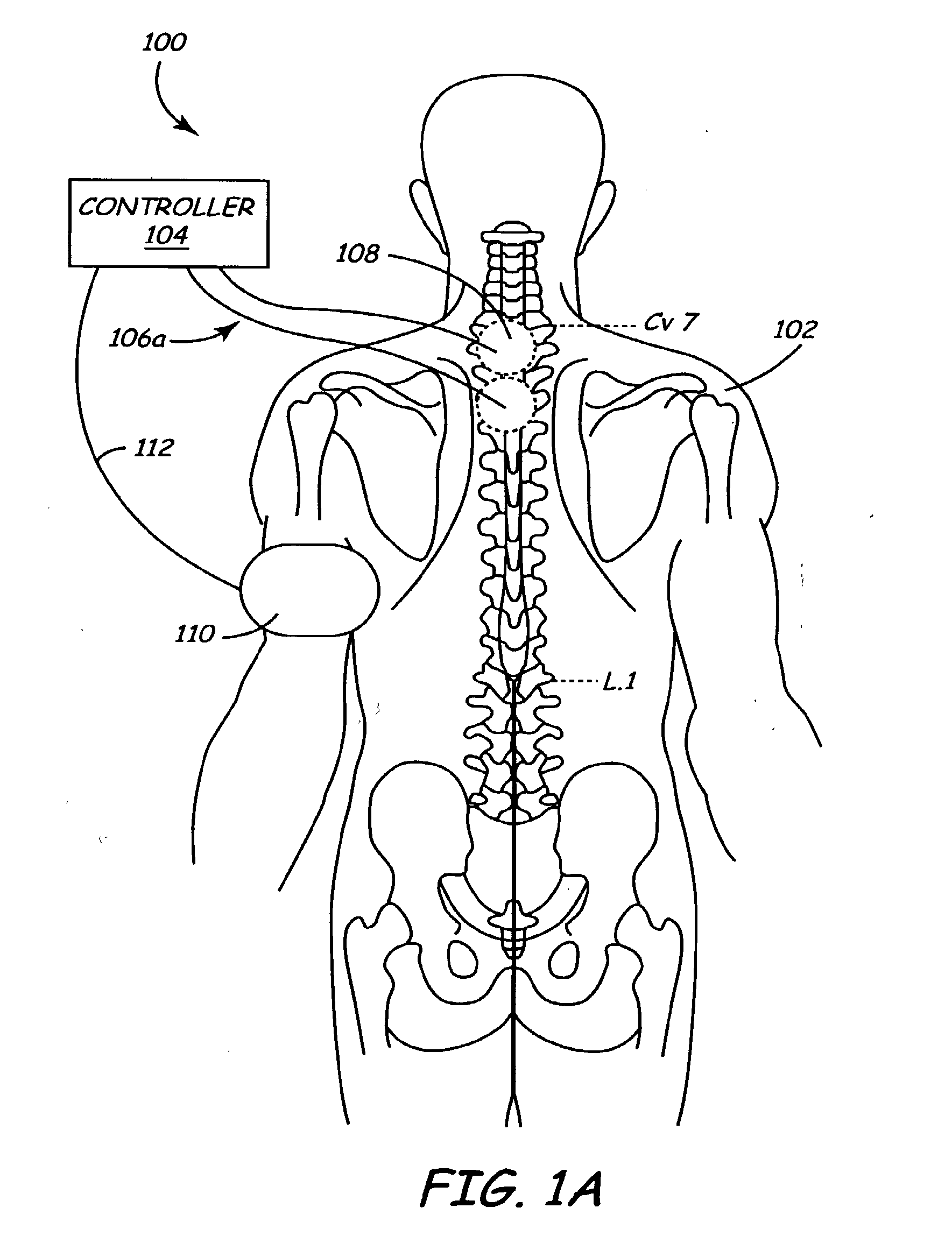 Method and apparatus for electrically stimulating the nervous system to improve ventricular dysfunction, heart failure, and other cardiac conditions