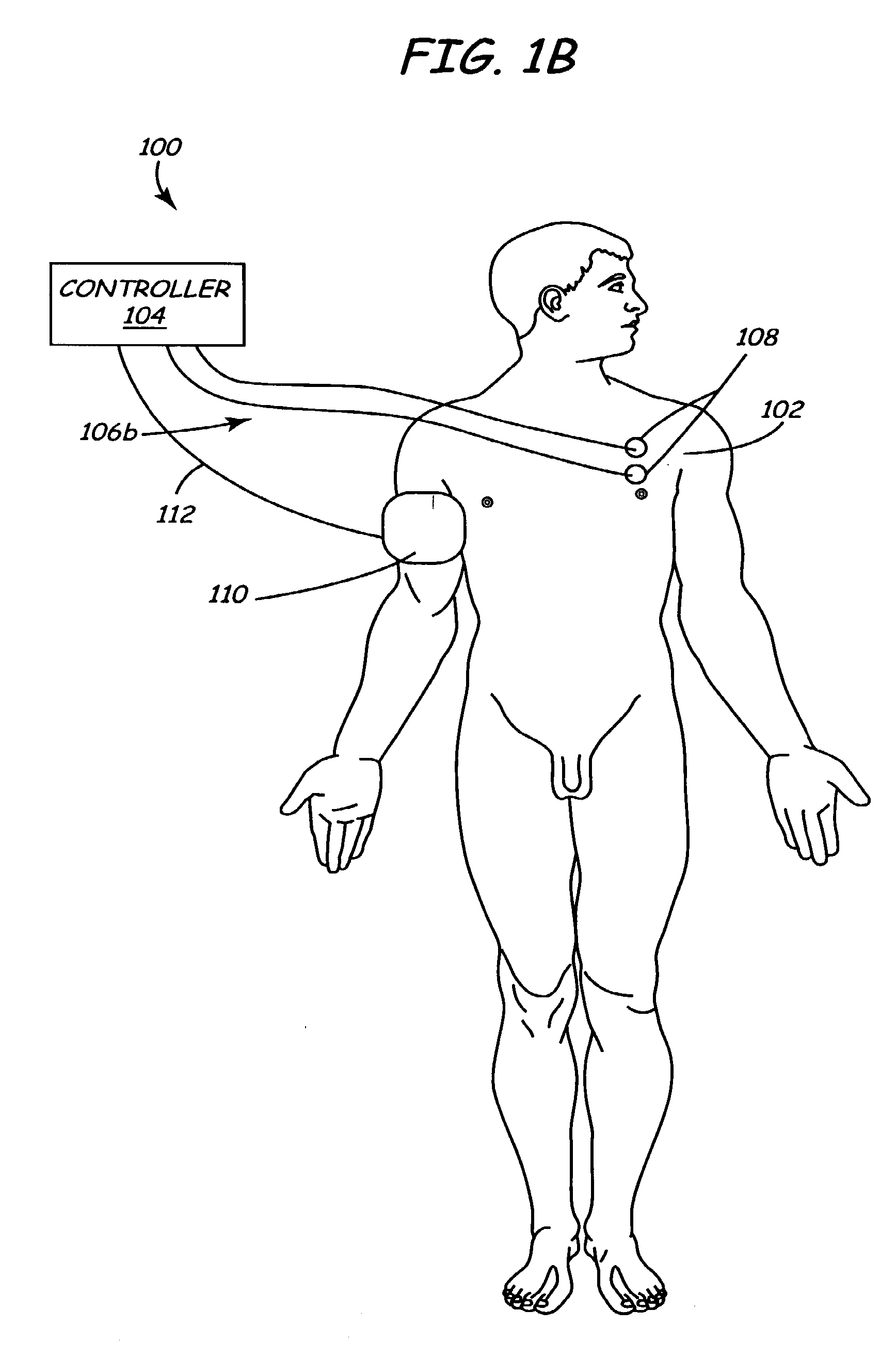 Method and apparatus for electrically stimulating the nervous system to improve ventricular dysfunction, heart failure, and other cardiac conditions