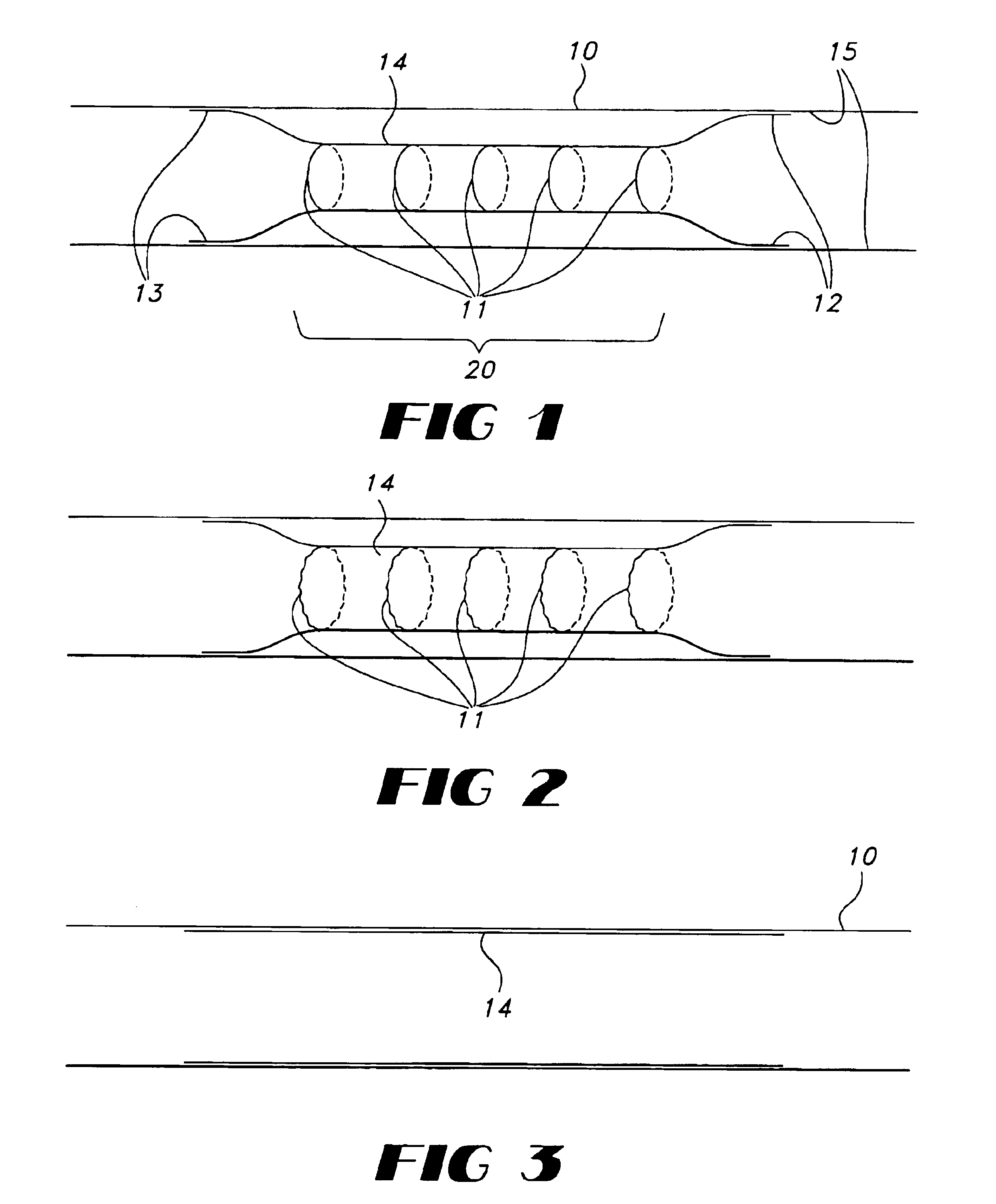 Stent with controlled expansion