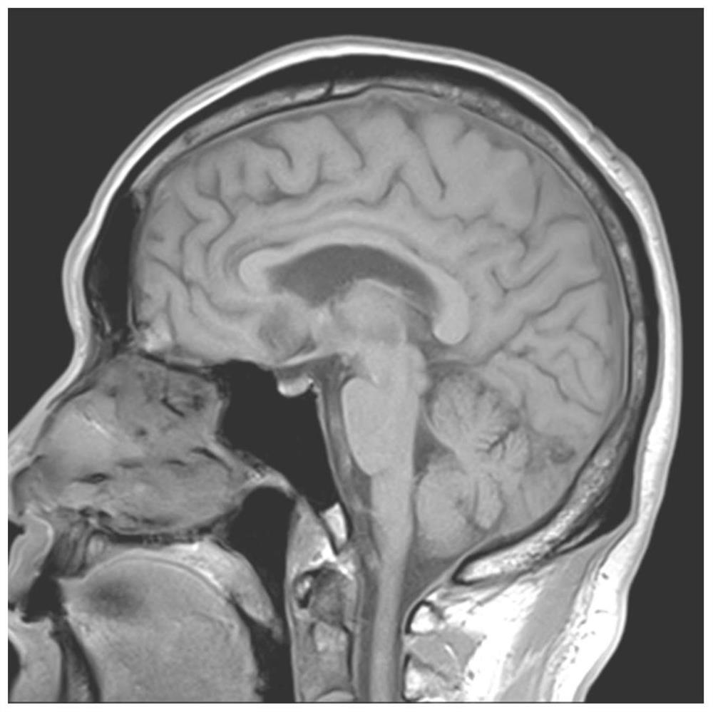 A Compressed Sampling MRI Image Reconstruction Method Based on Curvelet-Fista