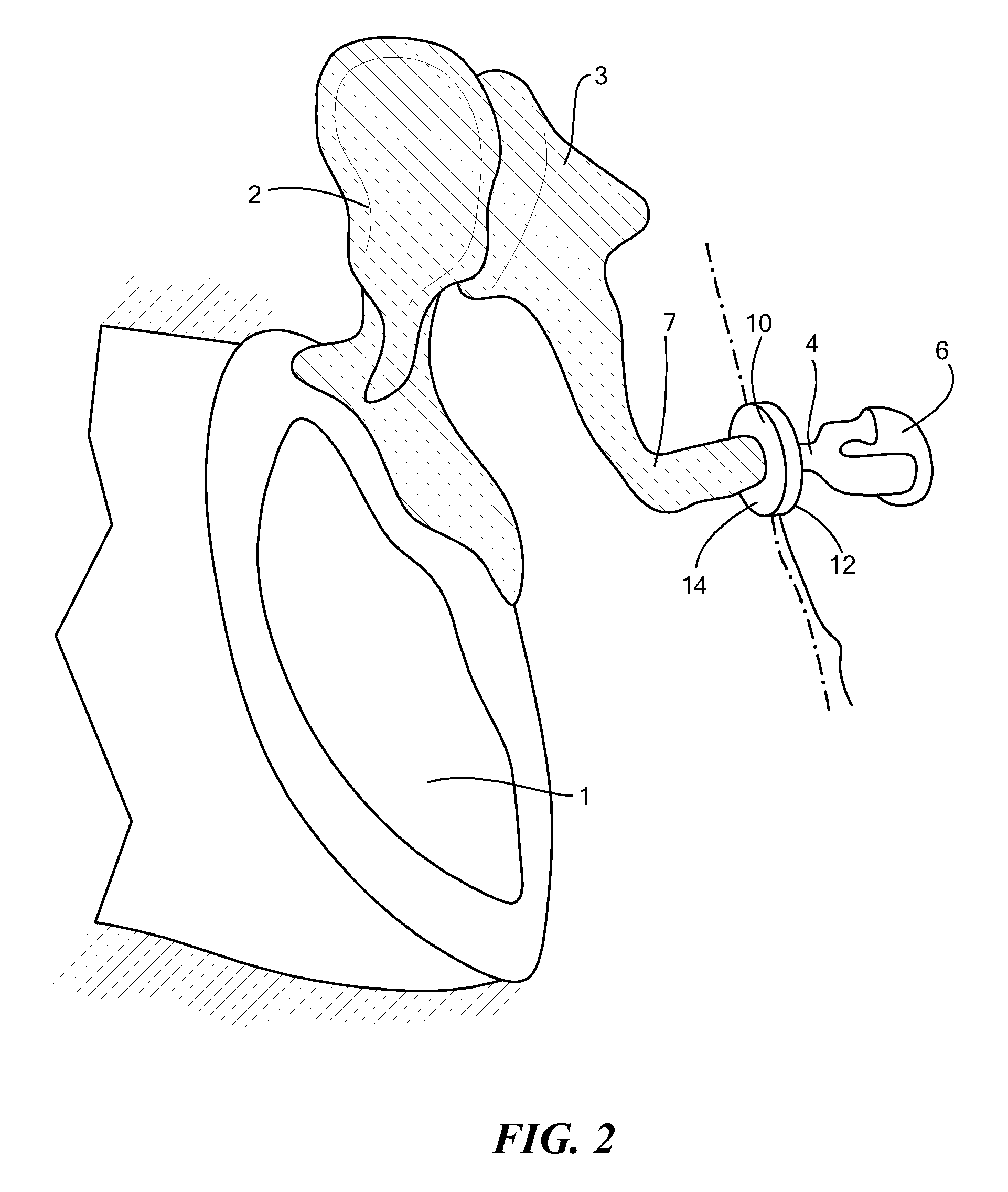 Implantable microphone for hearing systems