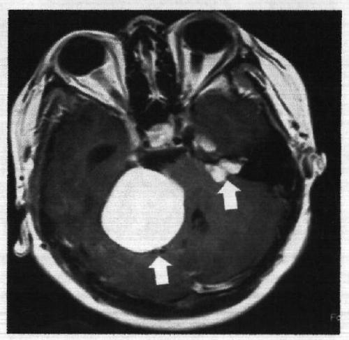 A kit for in vitro detection of the c.602deltg mutation of the neurofibromastosis 2 disease-causing gene NF2