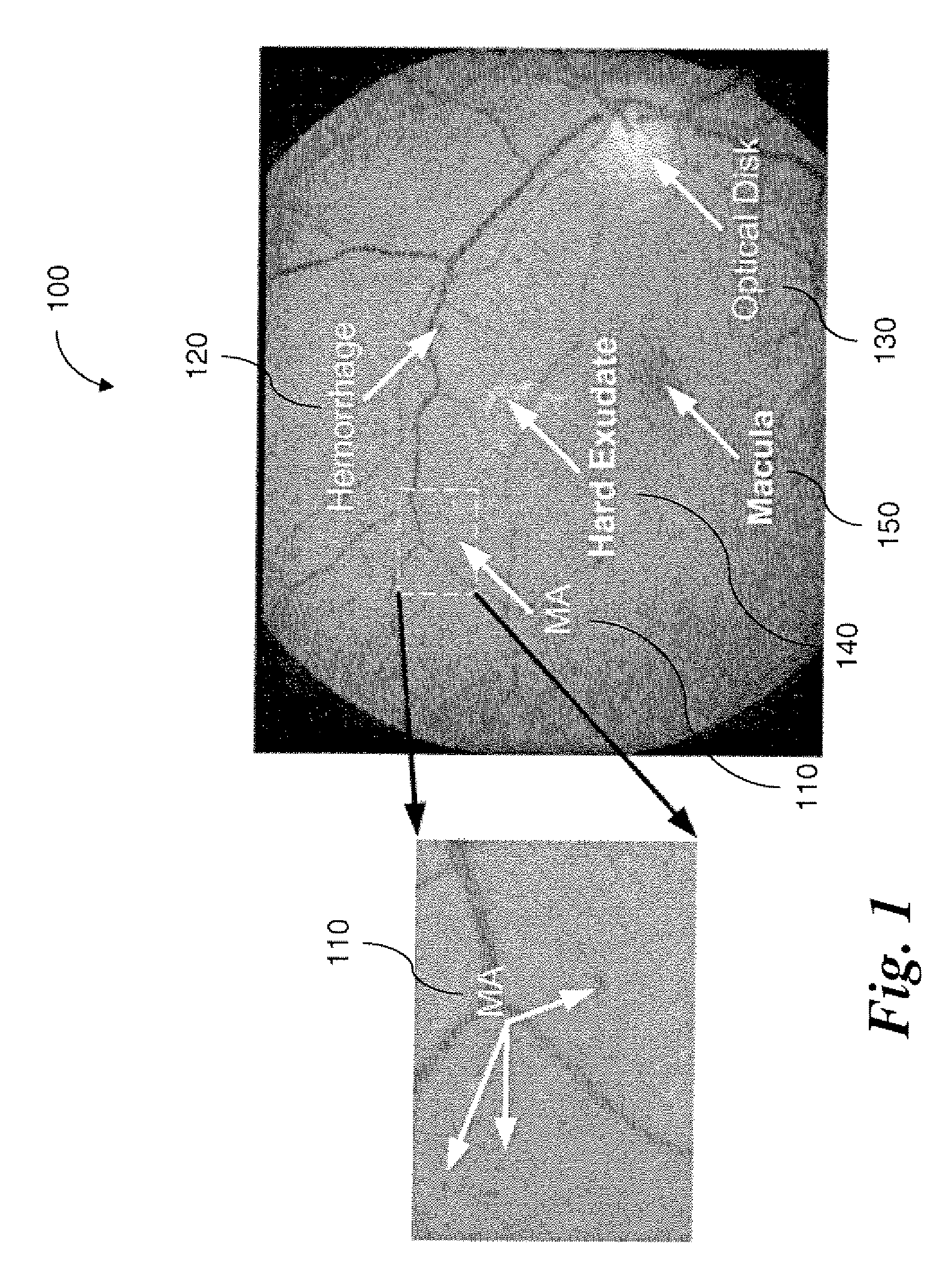 Method and System For Local Adaptive Detection Of Microaneurysms In Digital Fundus Images