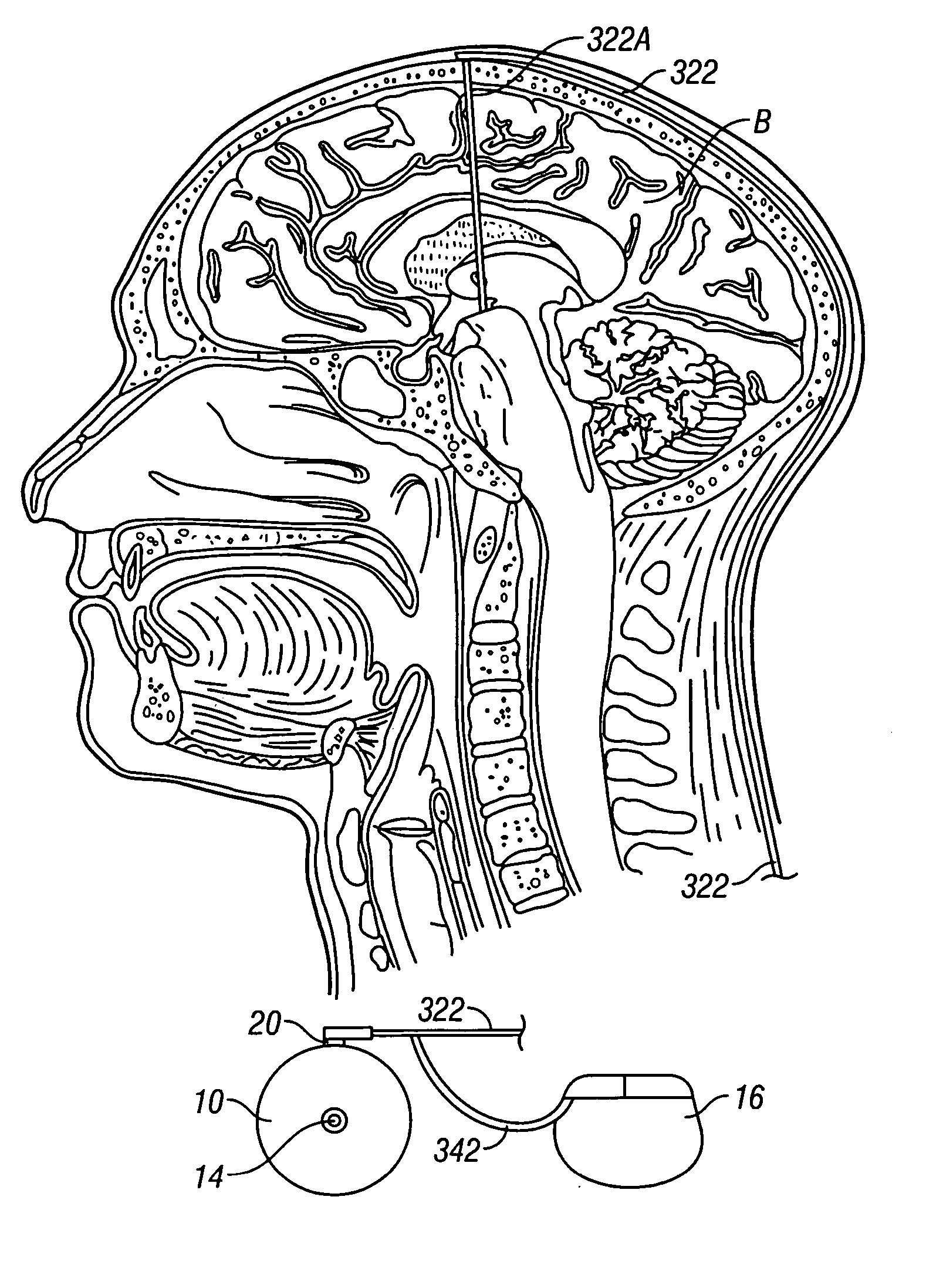 System and method of treating stuttering by neuromodulation