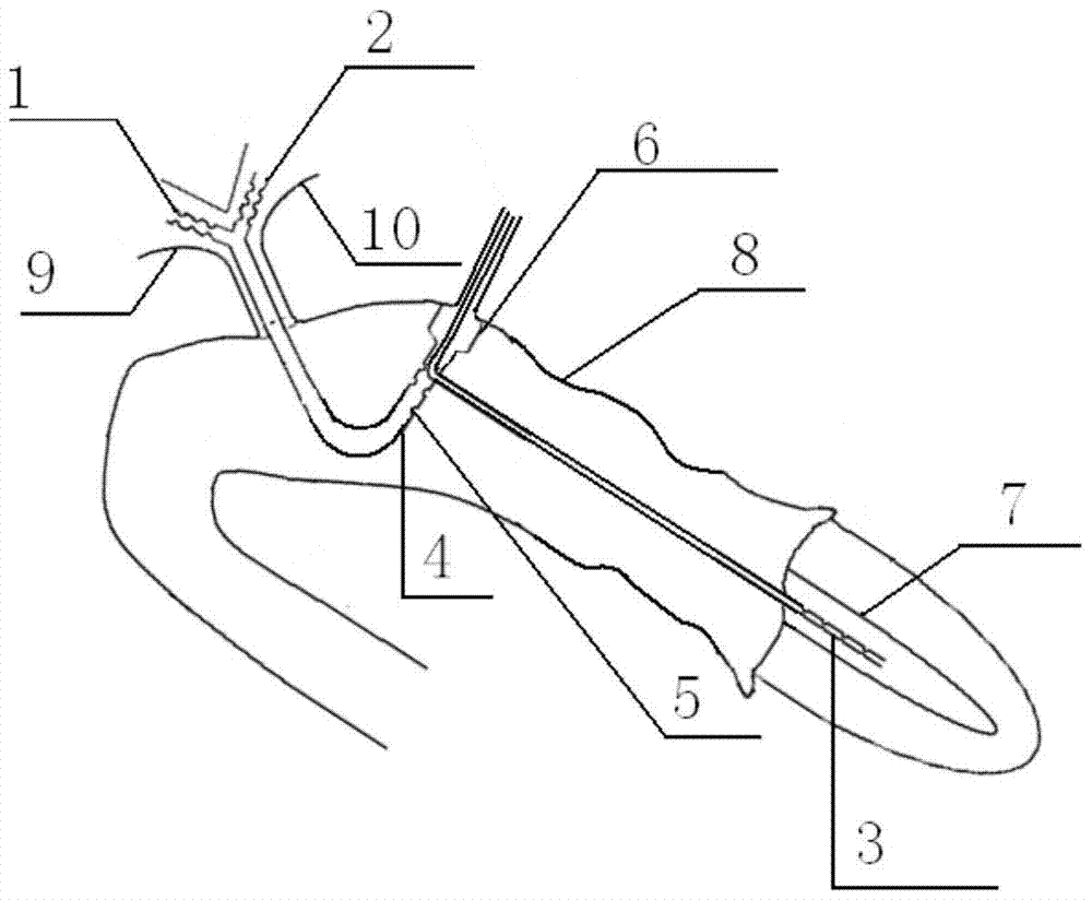 Biliary-pancreatic support drainage jejunostomy decompression tube