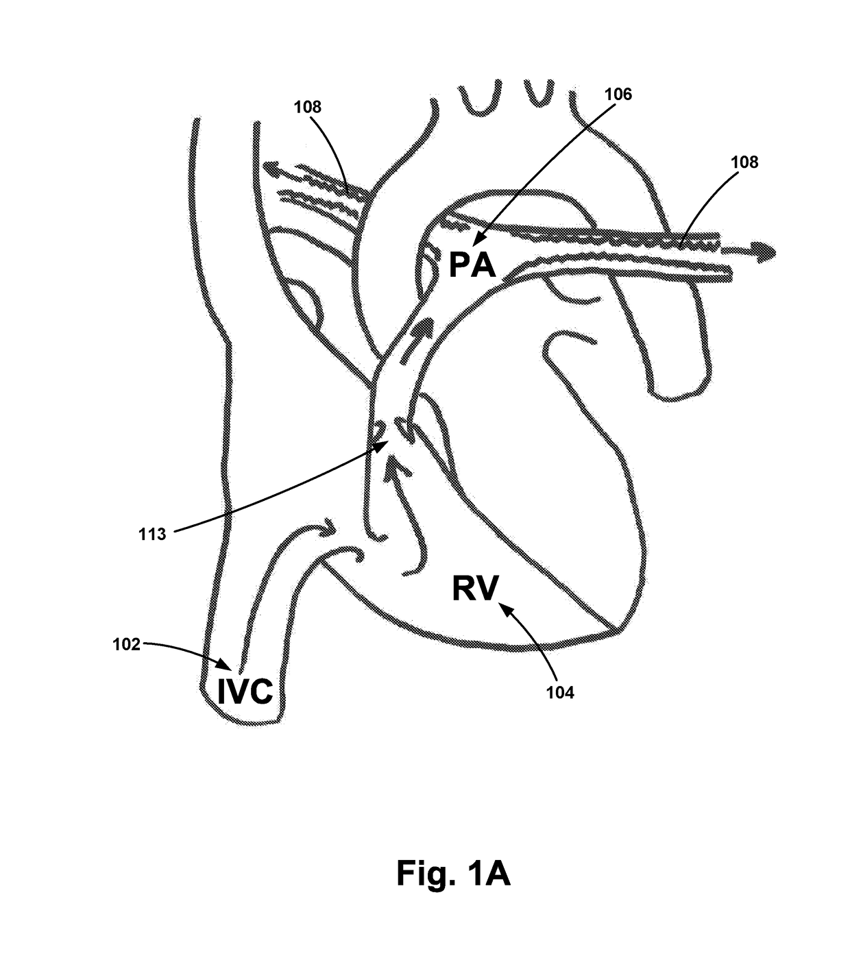 Pulmonary Embolism Apparatus