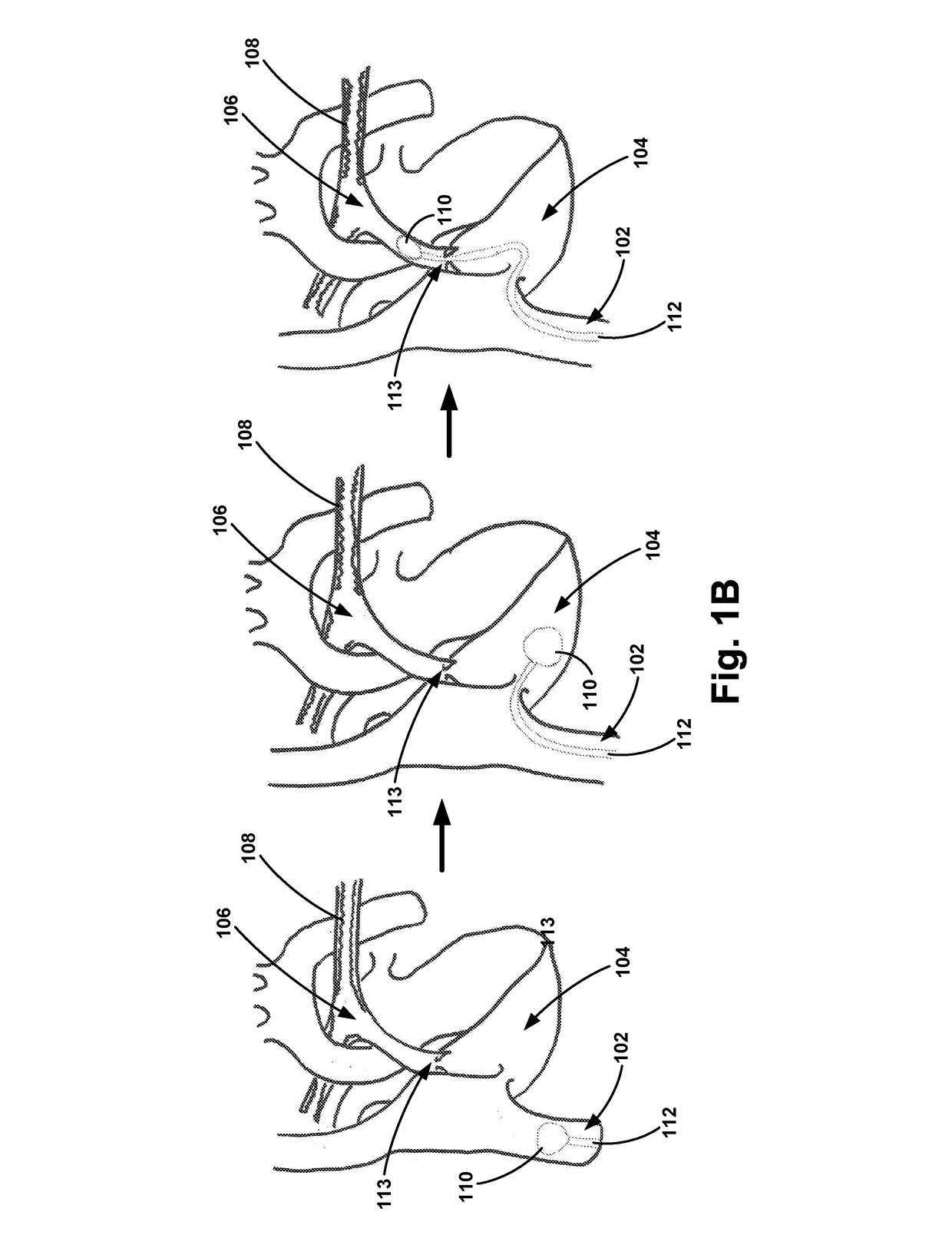 Pulmonary Embolism Apparatus