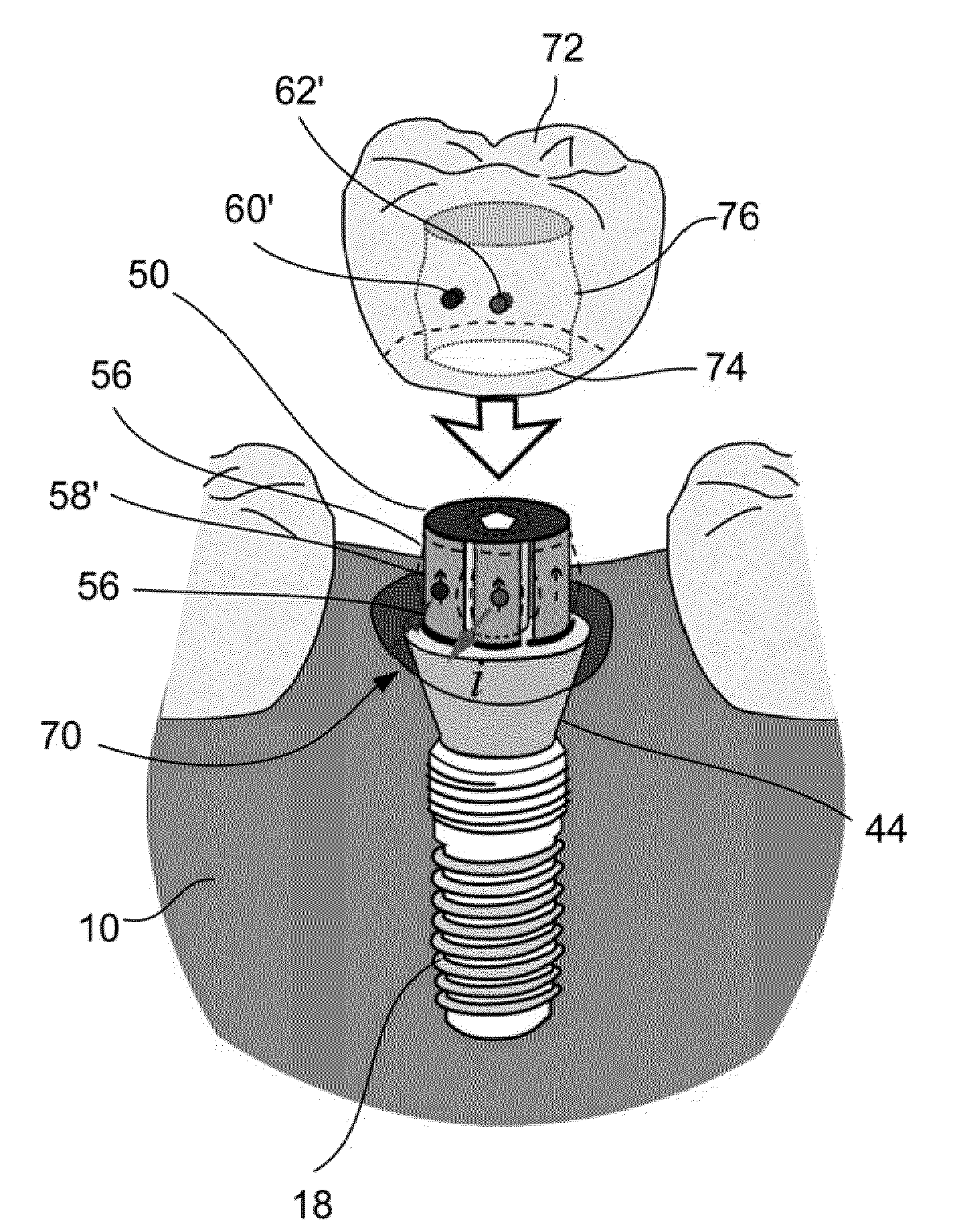 Shape memory dental retention systems