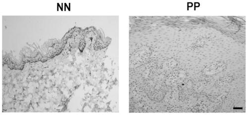 Method for knocking out PD-L1 gene in keratinocytes by CRISPR/Cas9 gene editing method