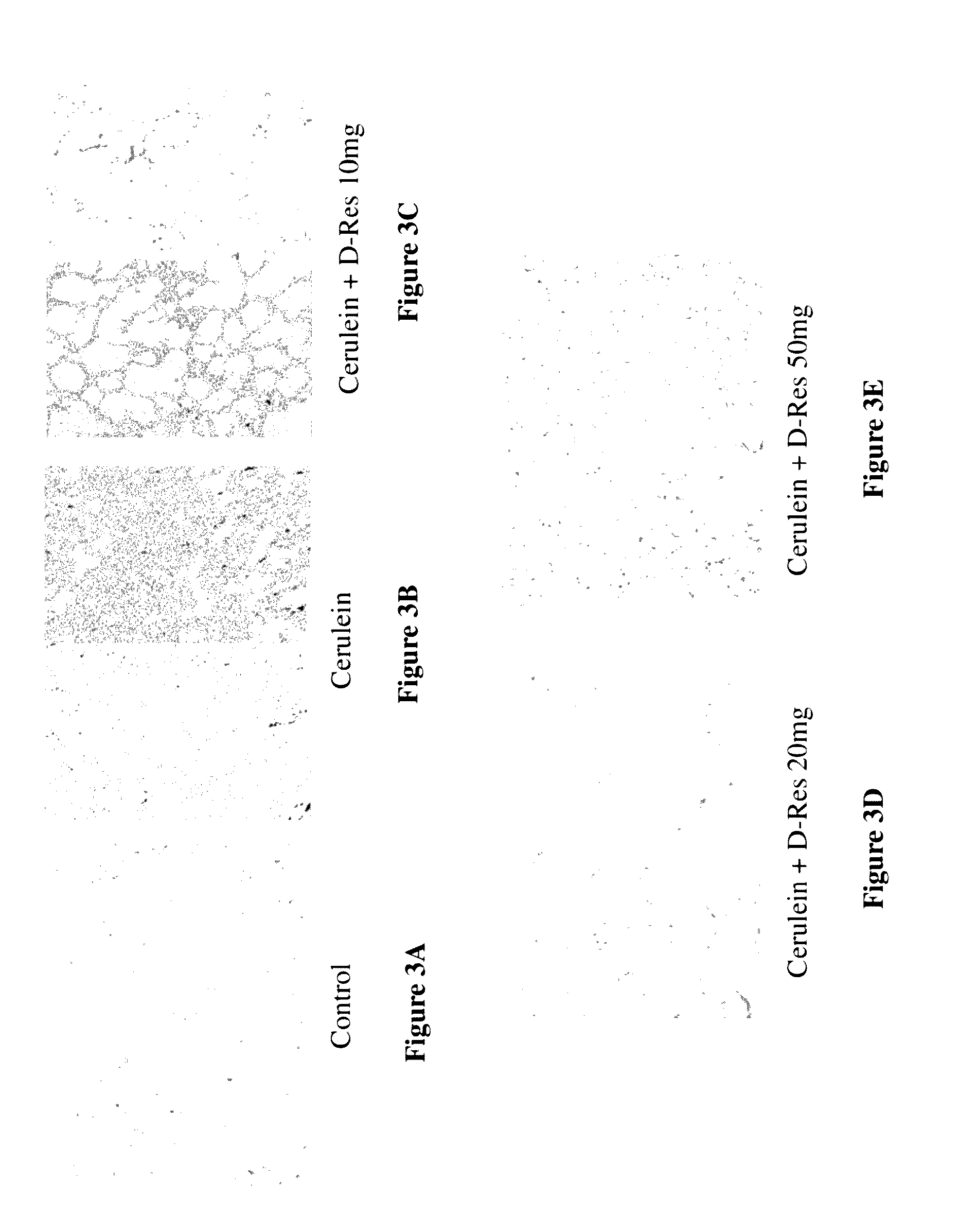 Method of Using Dihydro-Resveratrol for Treating Acute Pancreatitis and Associated Pulmonary Injury