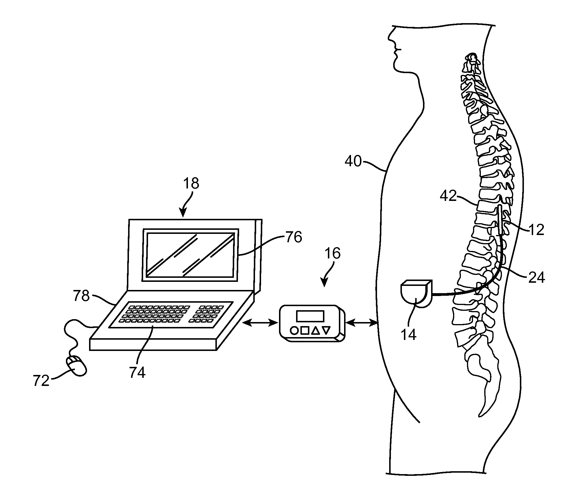 Neurostimulation system for estimating desired stimulation amplitude for electrode configuration