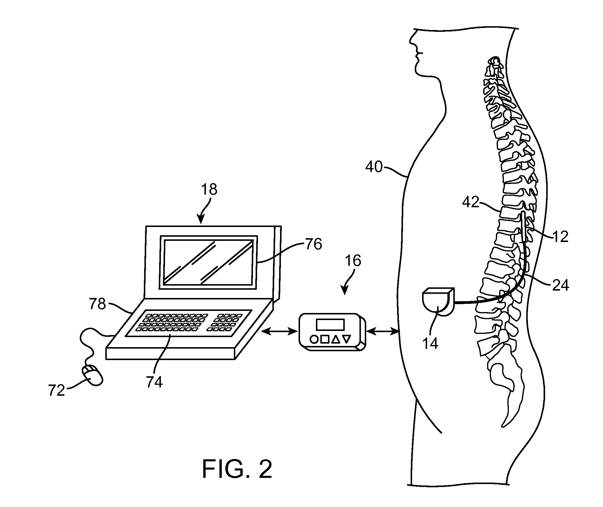 Neurostimulation system for estimating desired stimulation amplitude for electrode configuration