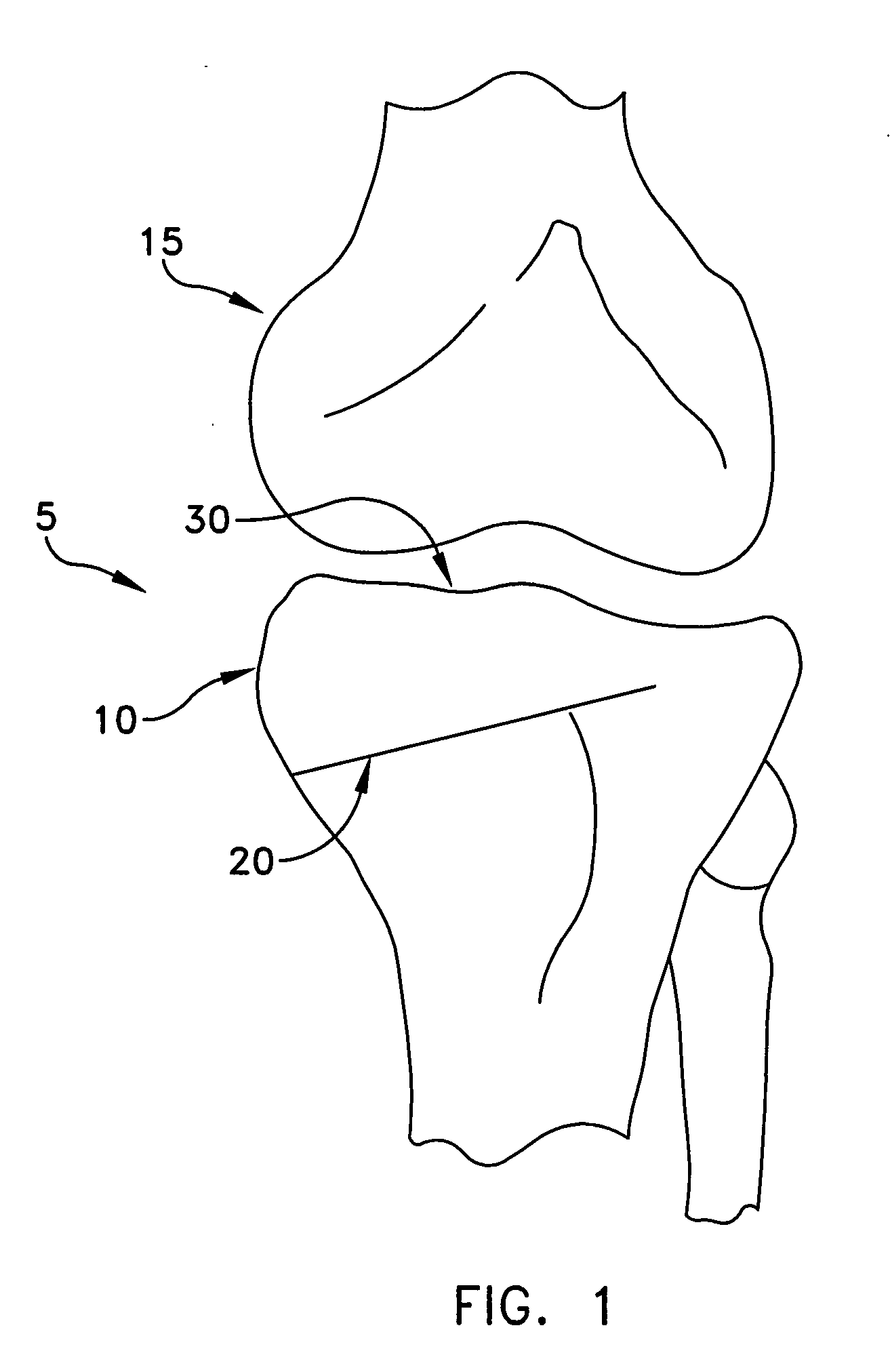 Method and apparatus for performing an open wedge, high tibial osteotomy