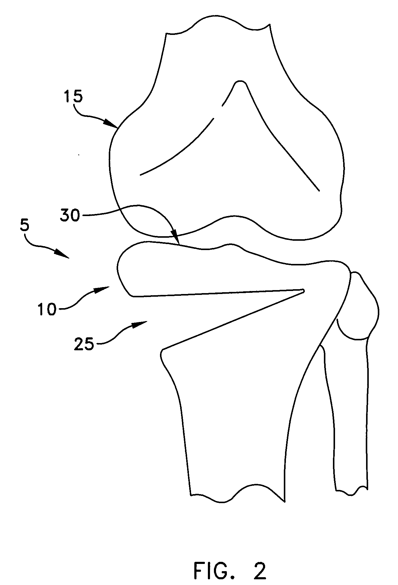 Method and apparatus for performing an open wedge, high tibial osteotomy
