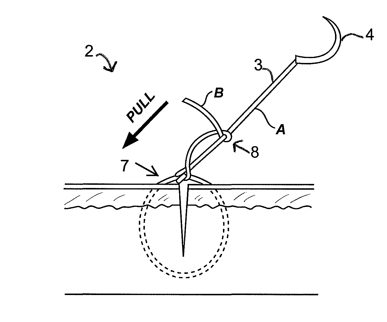 Gliding stitch for closing wounds under tension