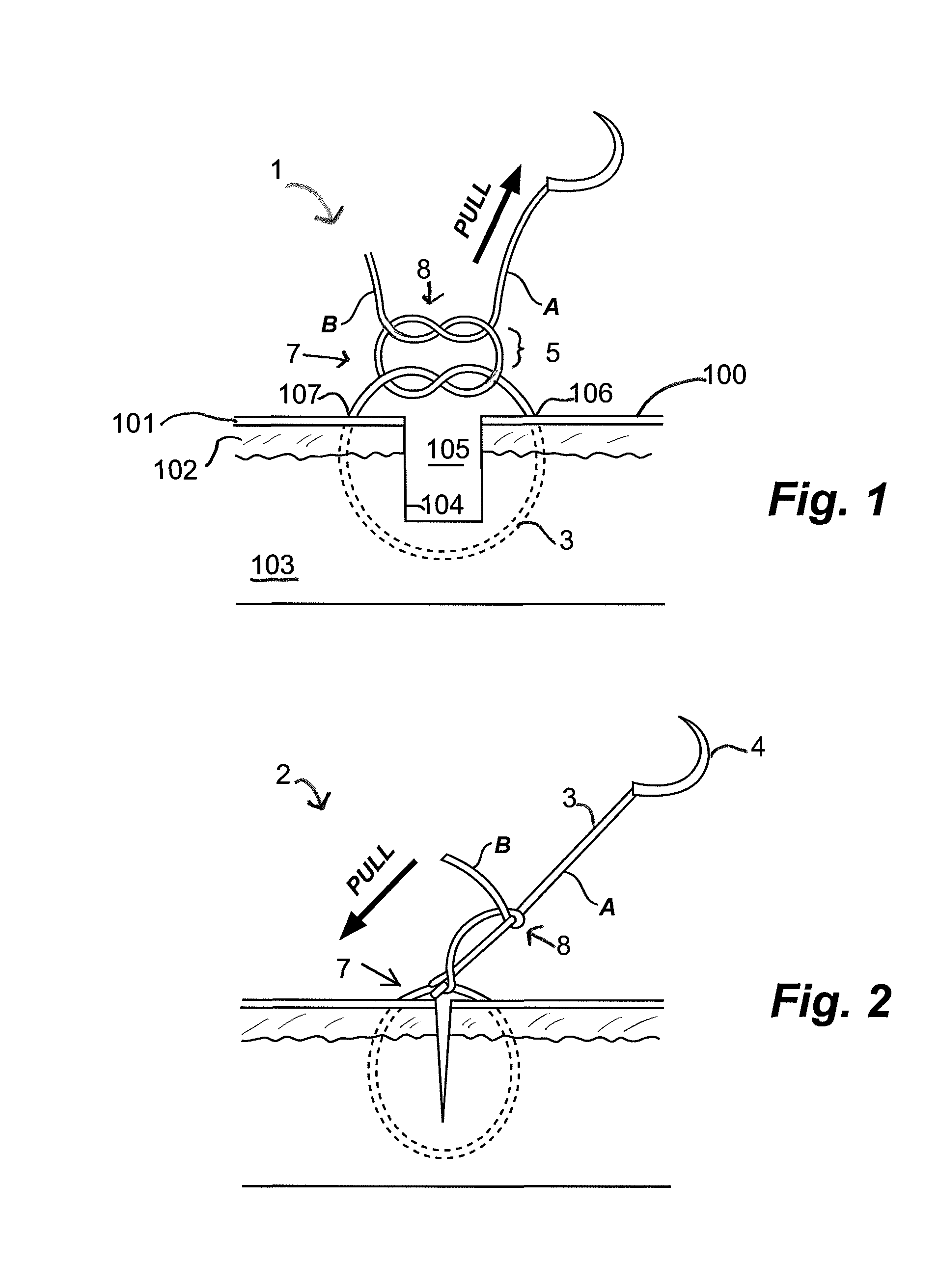 Gliding stitch for closing wounds under tension