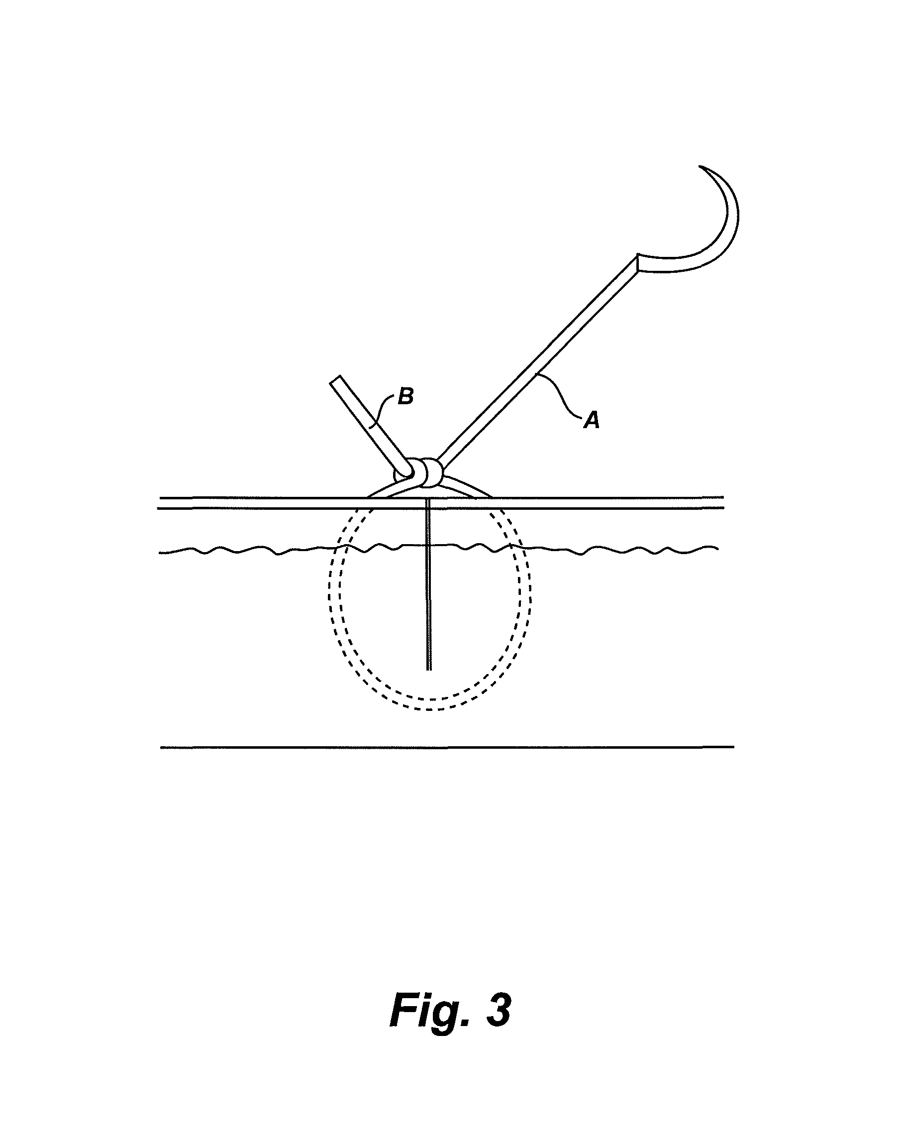 Gliding stitch for closing wounds under tension