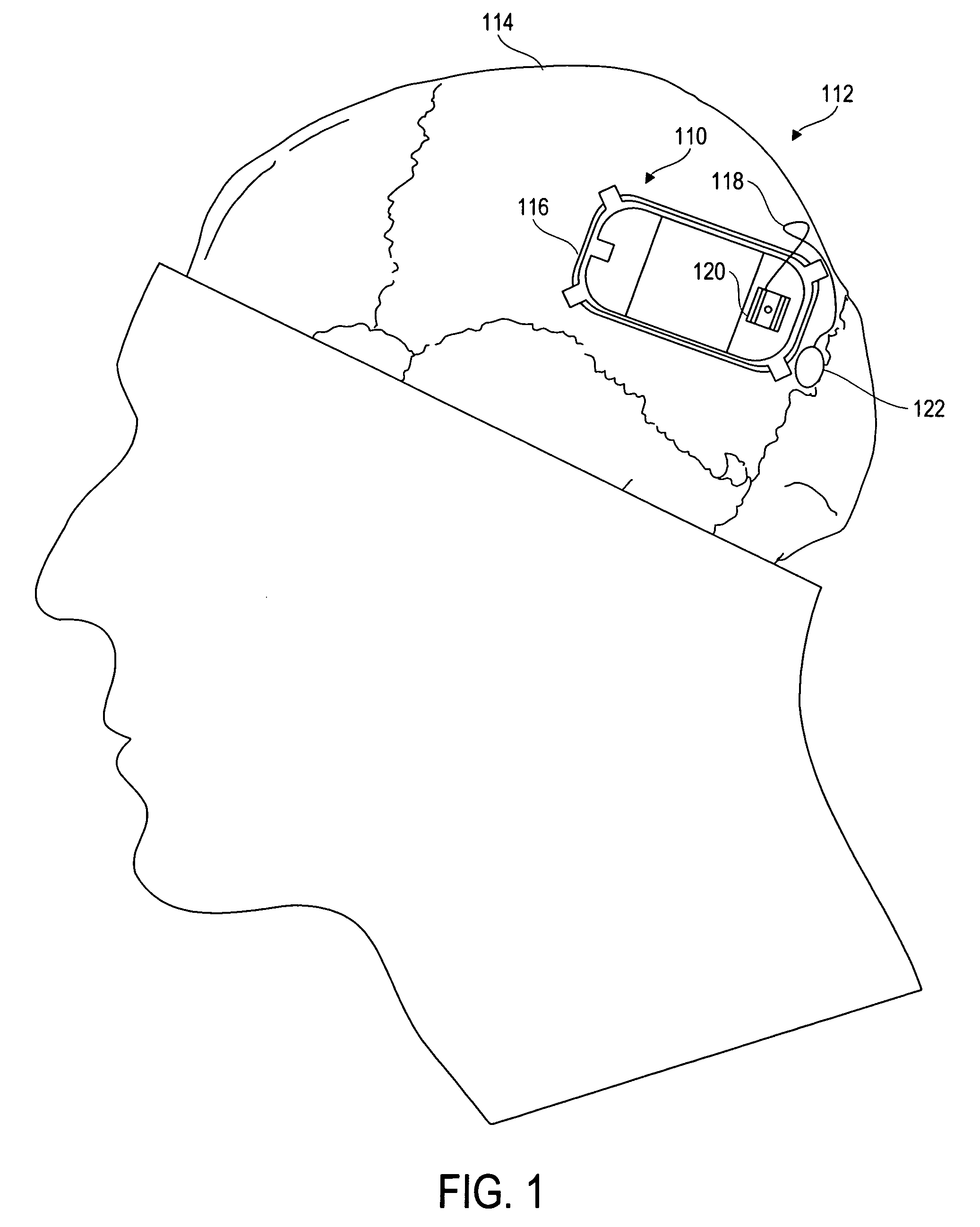 Implantable lead system with seed electrodes