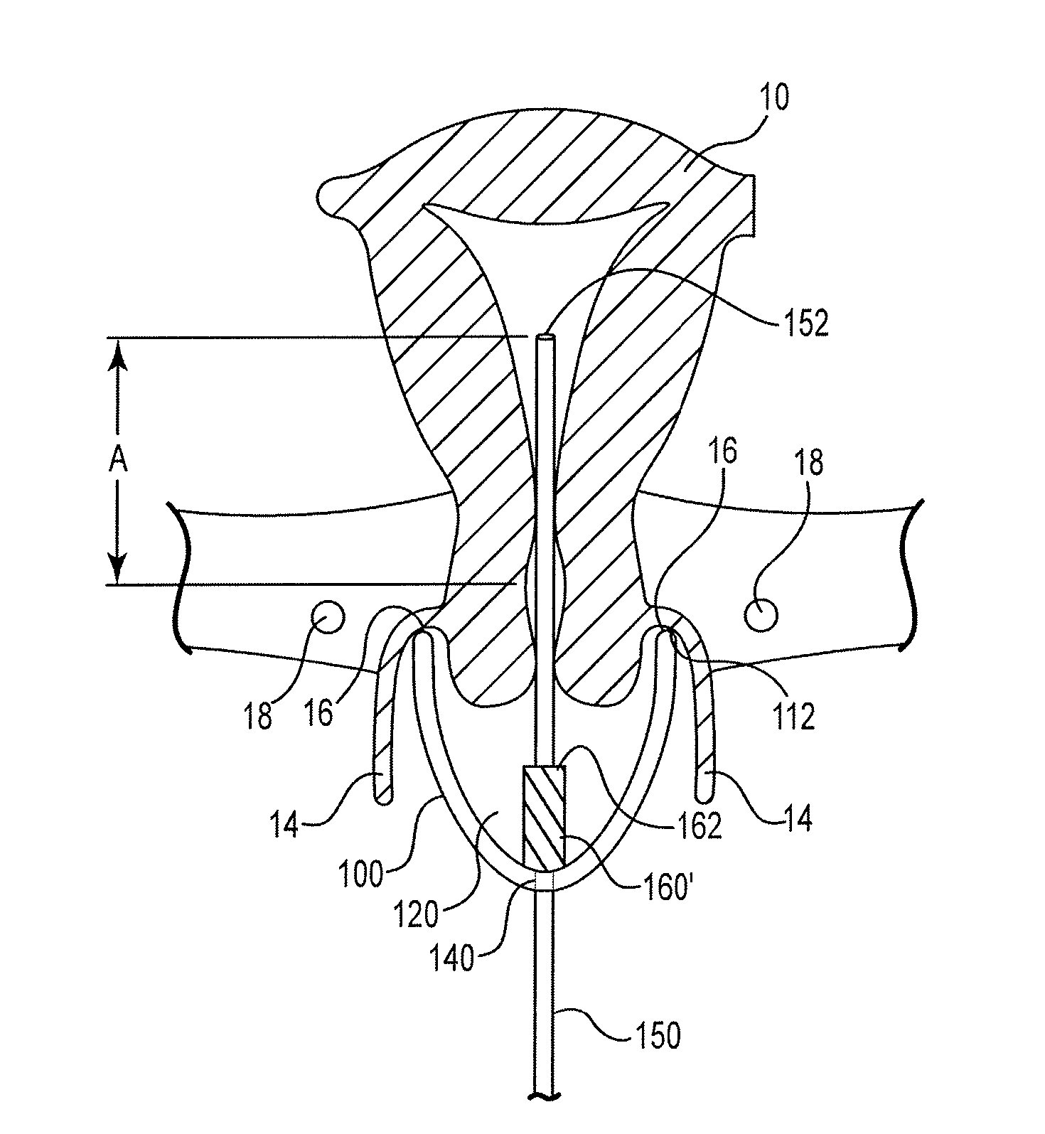 Device and method for illumination of vaginal fornix with ureter location, isolation and protection during hysterectomy procedure