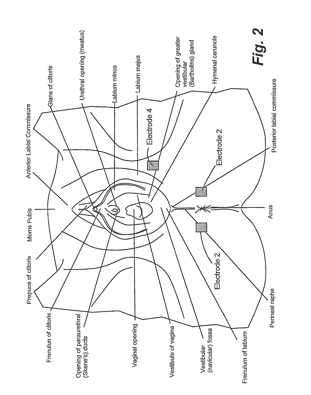 Diagnosis of brain and spinal cord injury by bulbocavernosus reflex measurement