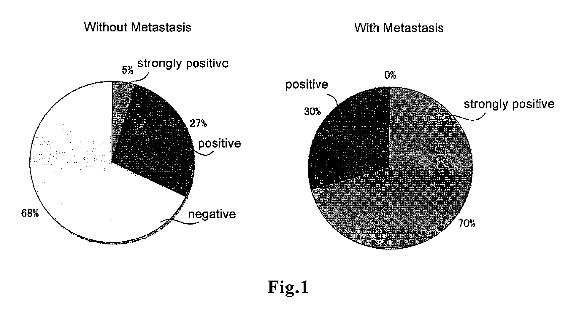 Method for determination of prognosis of prostate cancer, and diagnostic agent for use in the method